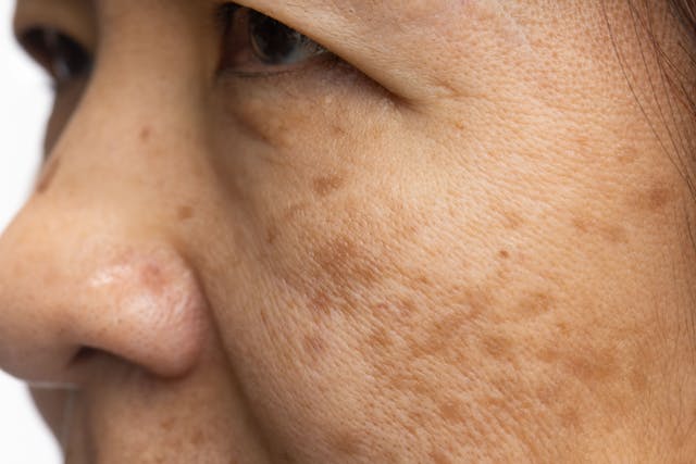 Combining Microneedling and Tranexamic Acid for Melasma: Efficacy and Satisfaction