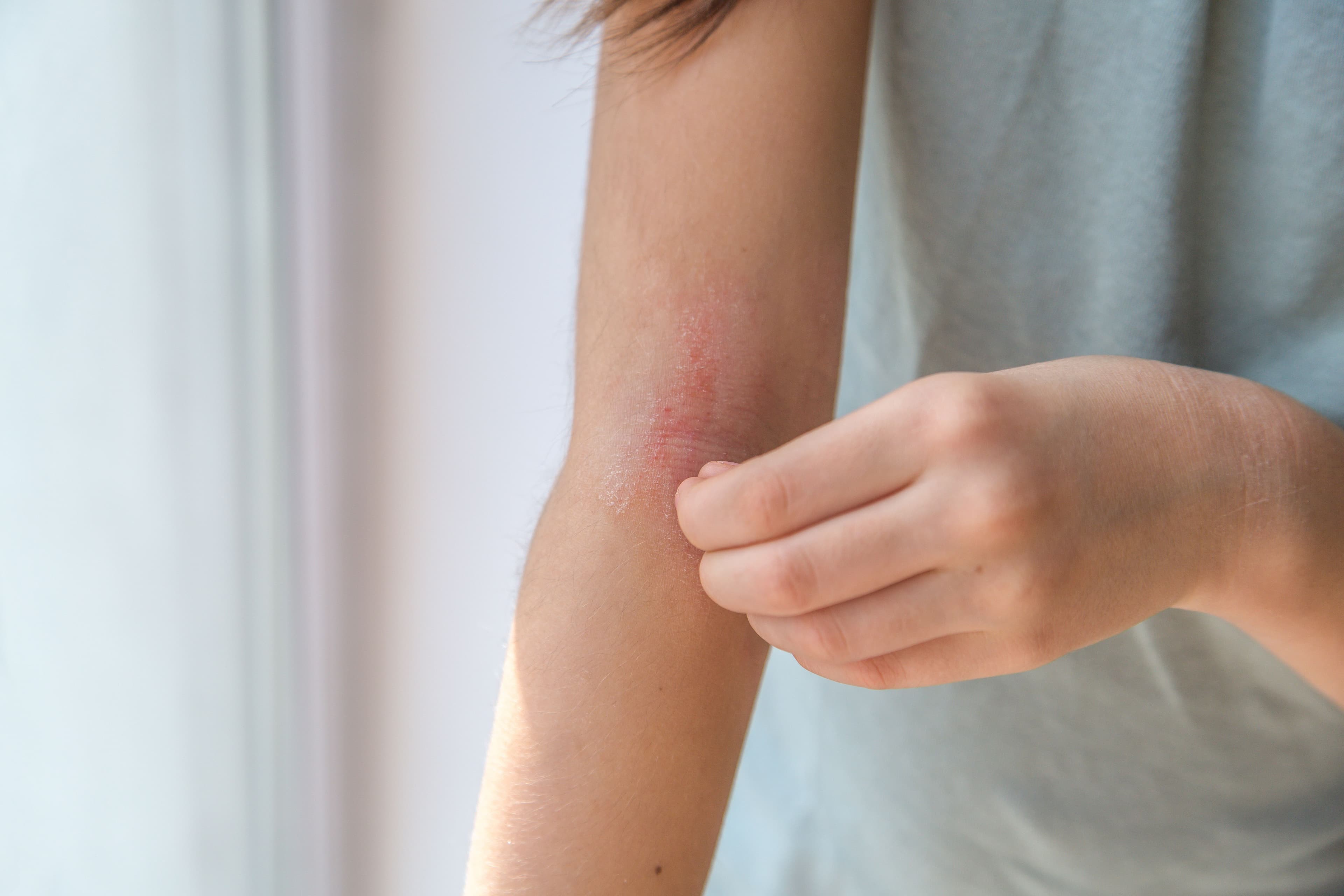 atopic dermatitis on arm | Image Credit: © Evgeniya Primavera - stock.adobe.com