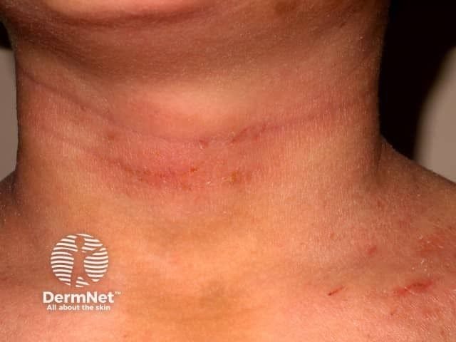 Atopic dermatitis of the neck | Image credit: © DermNet