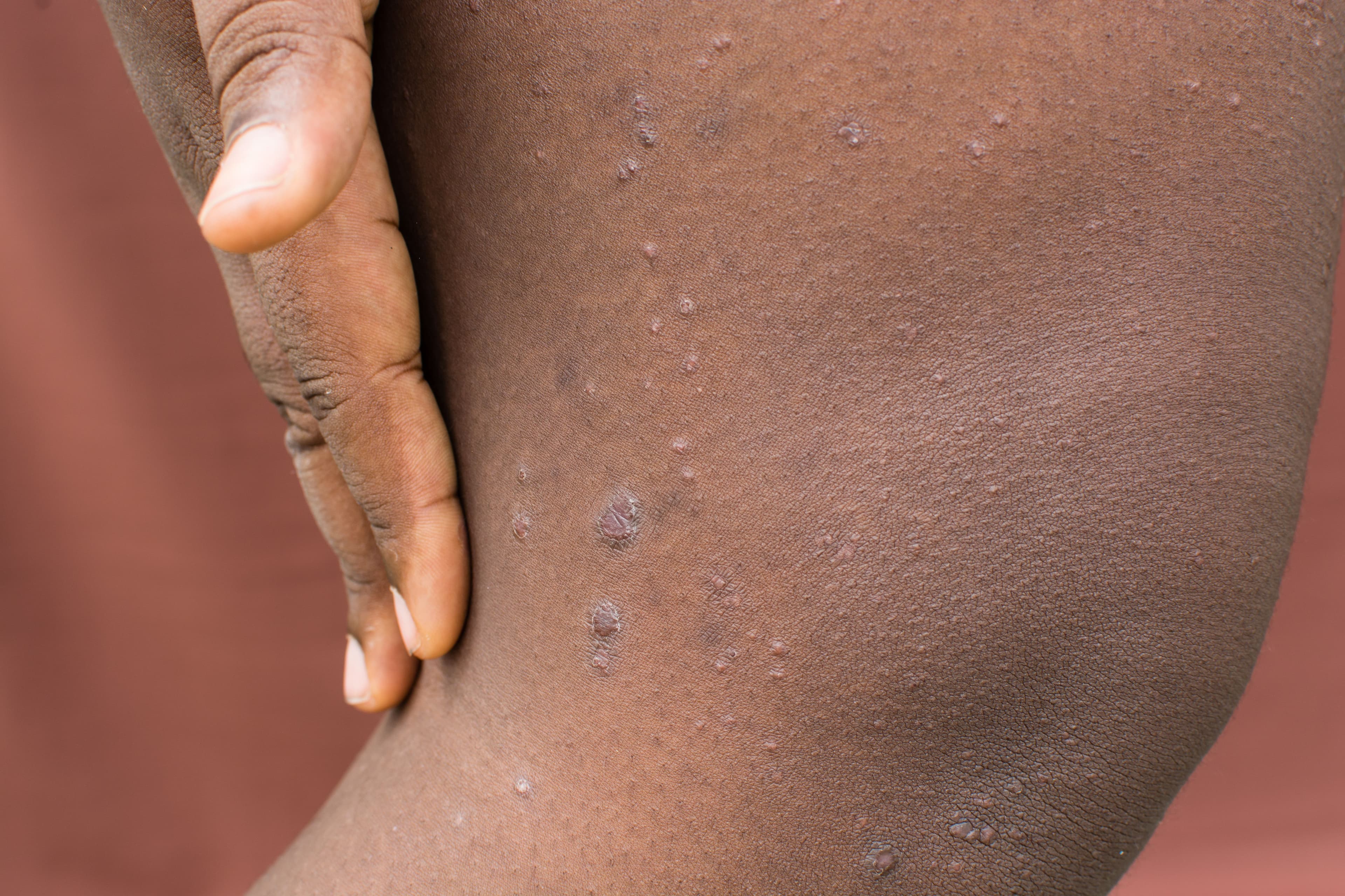 patient with pruigo nodularis | Image Credit: © this_baker - stock.adobe.com