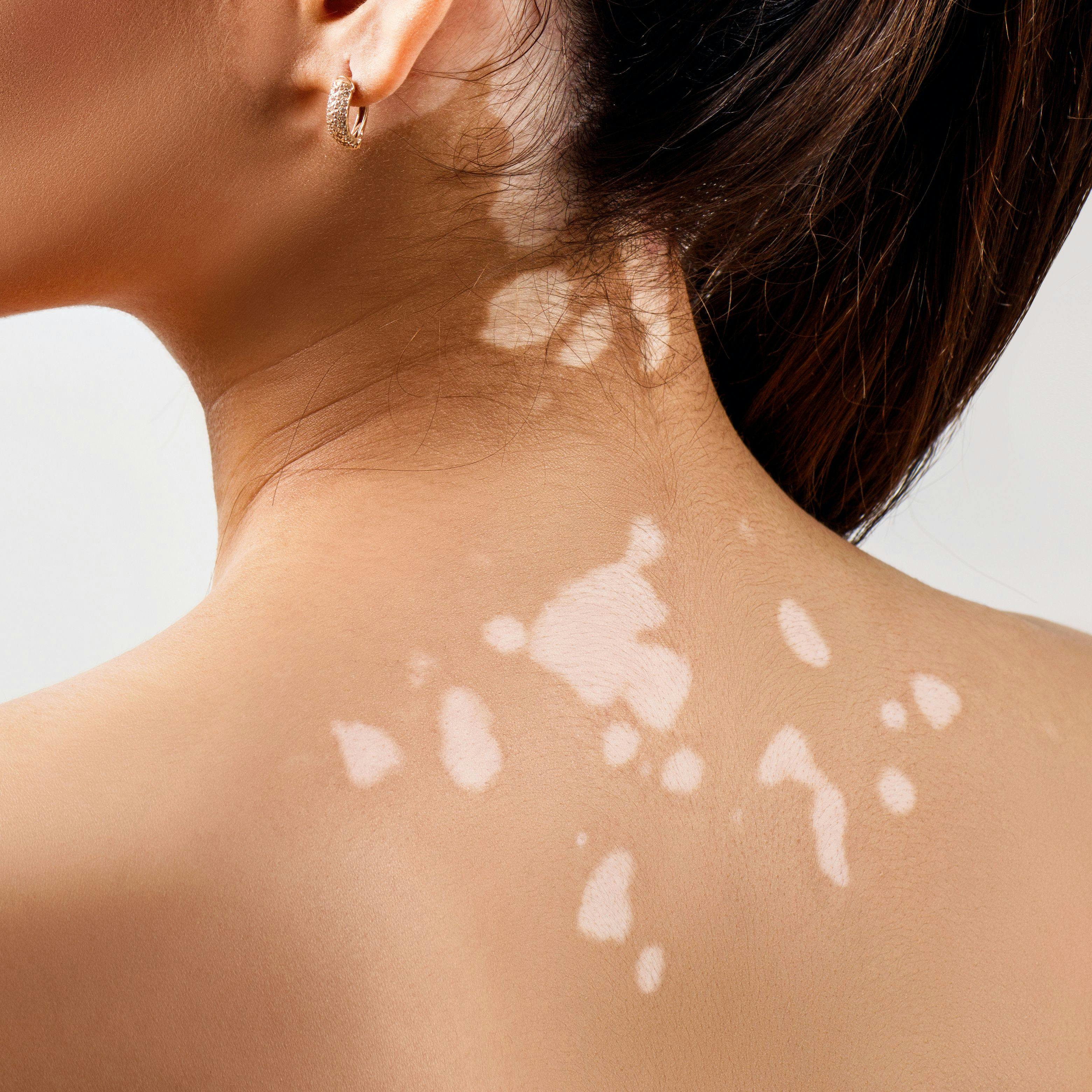 Woman with vitiligo on her back and neck | Image Credit: © Dmitrii Kotin - stock.adobe.com