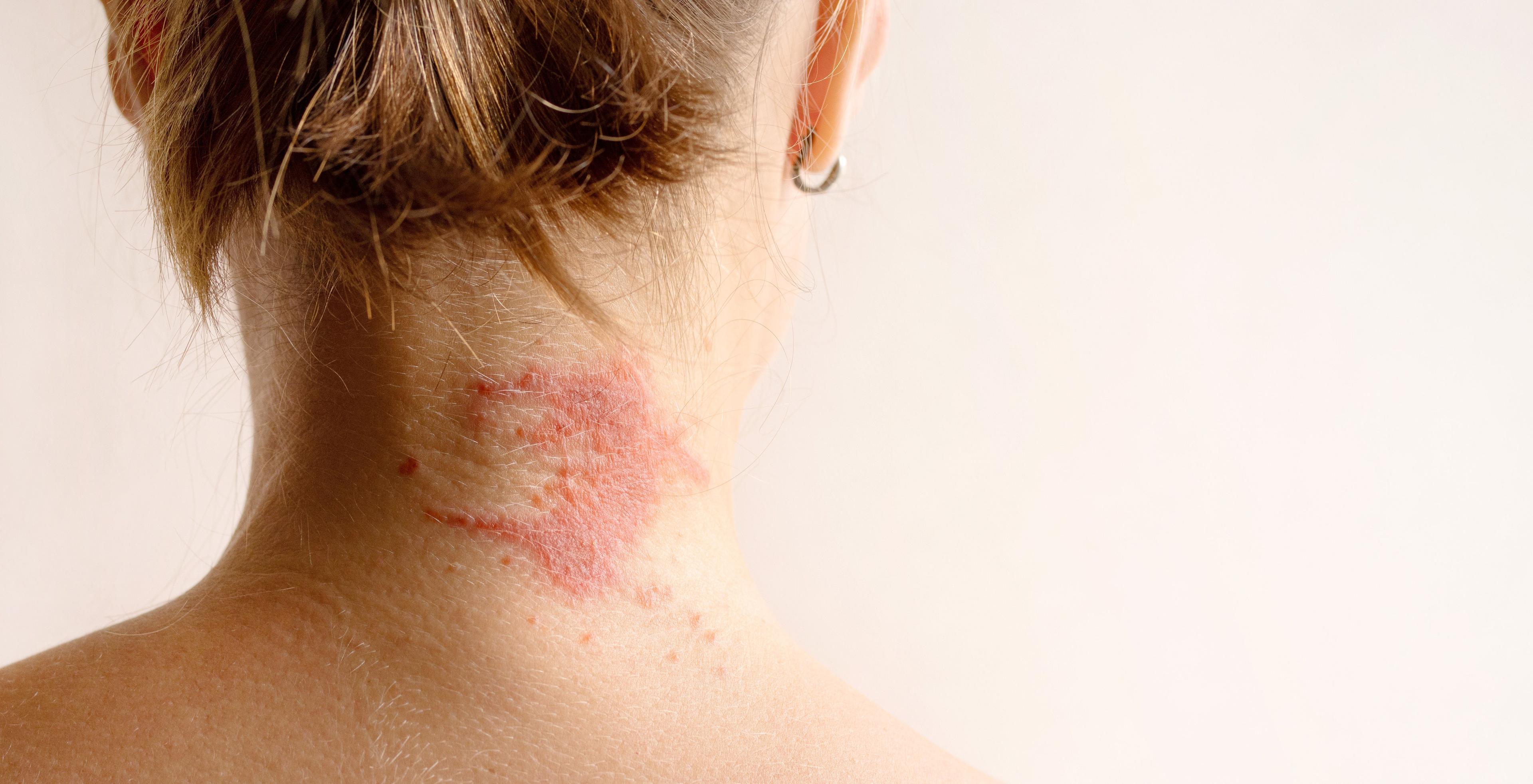 Atopic dermatitis on the back of the neck