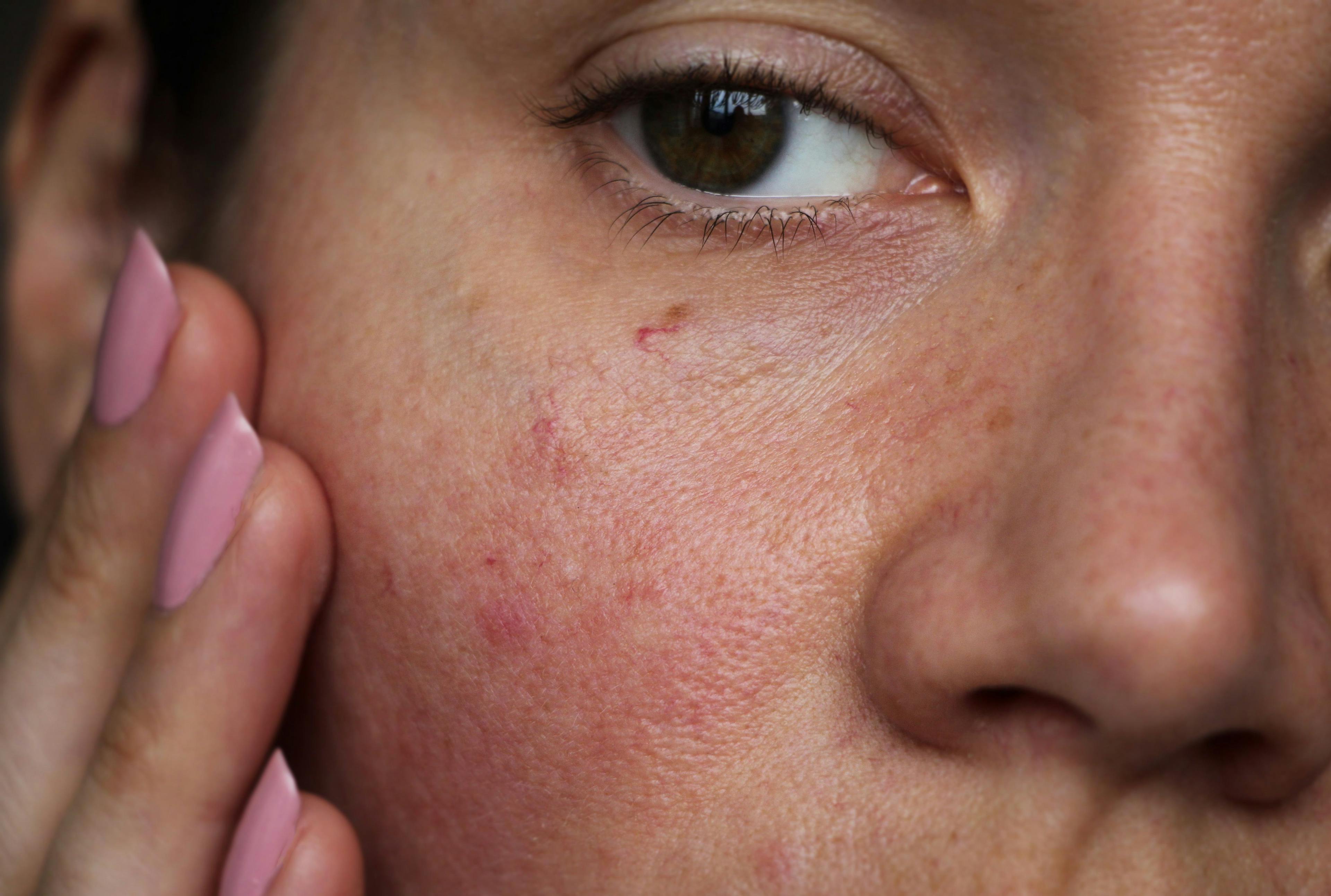 Girl with burst capillaries on face | Image Credit: © Angelina - stock.adobe.com.