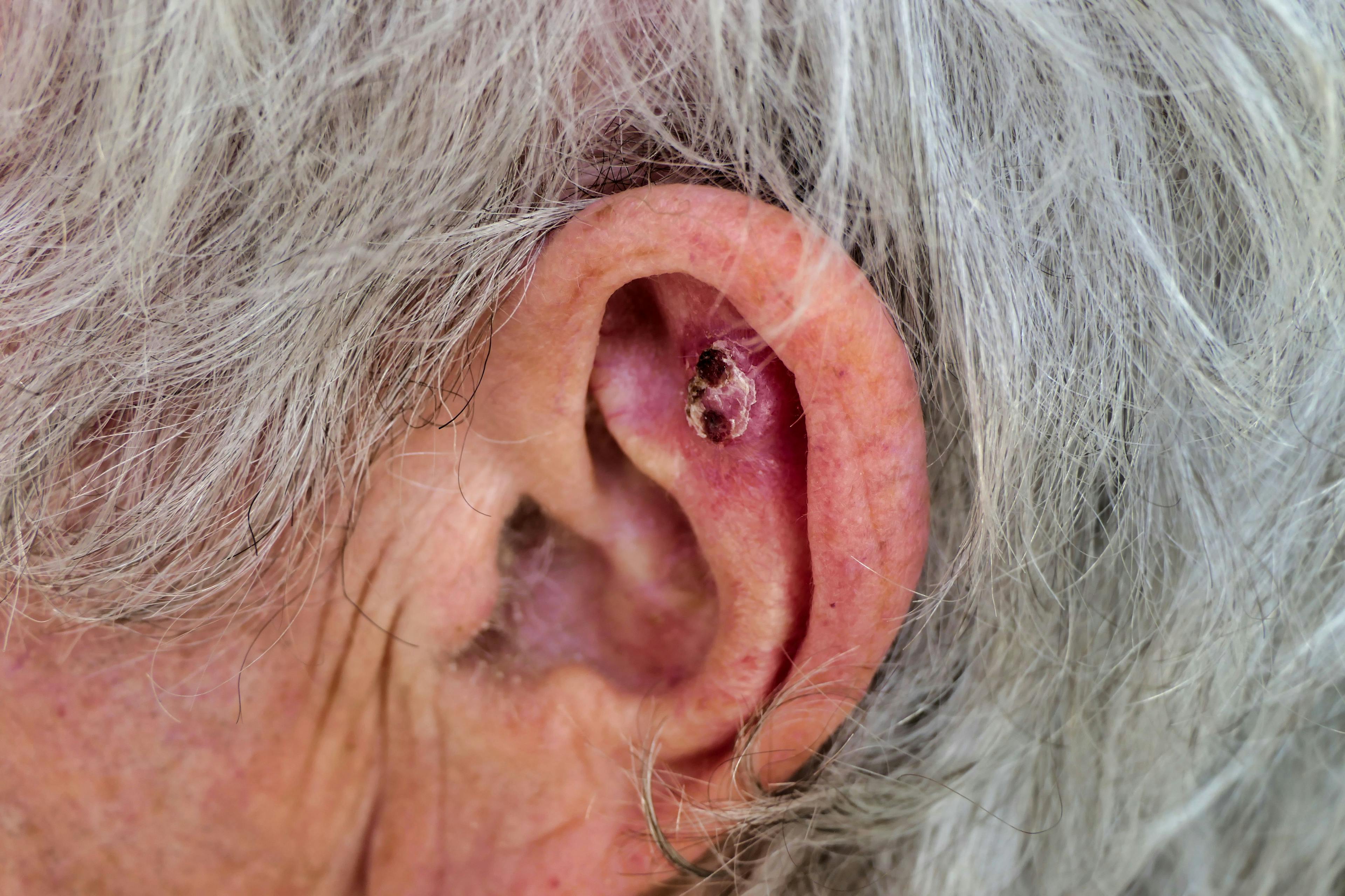 Basal cell carcinoma on a patient's ear | Image Credit: © plazaccameraman - stock.adobe.com