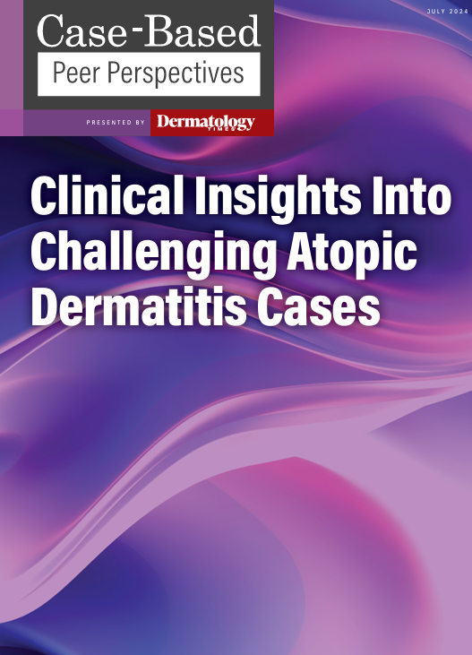 Clinical Insights Into Challenging Atopic Dermatitis Cases: Part 2