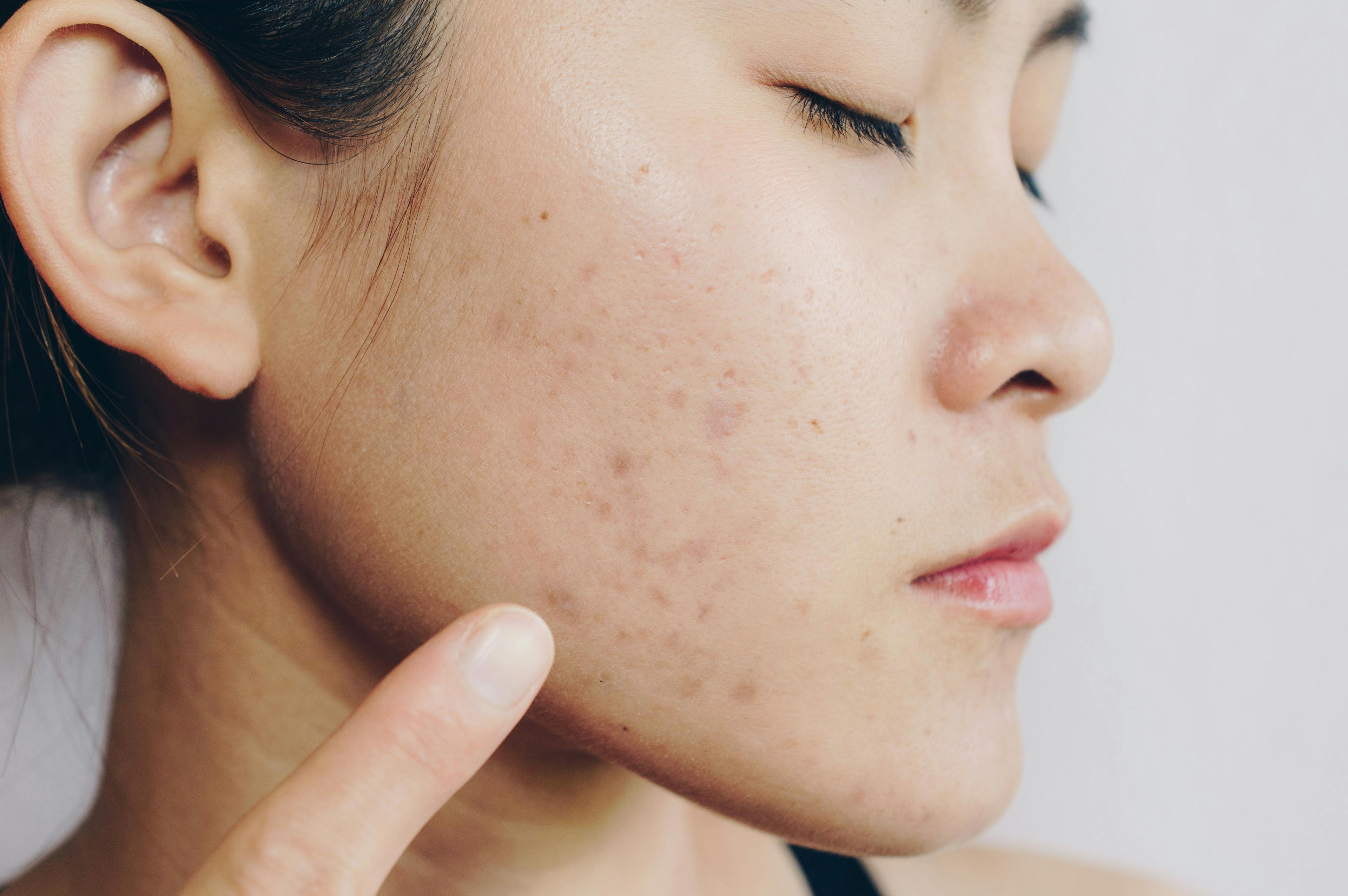 Woman pointing to acne scars on the cheek and jawline