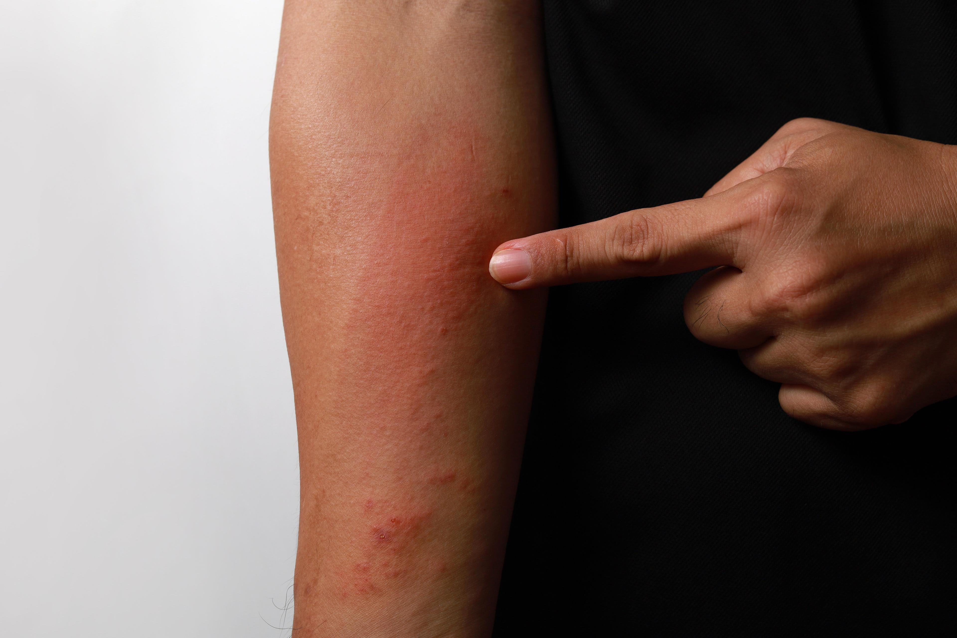 Person pointing to atopic dermatitis on the arm