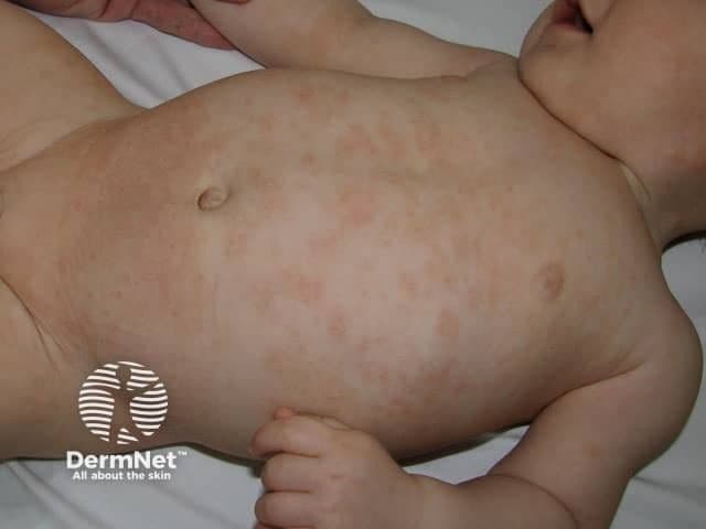 Child with atopic dermatitis | Image Credit: © dermnetnz.org