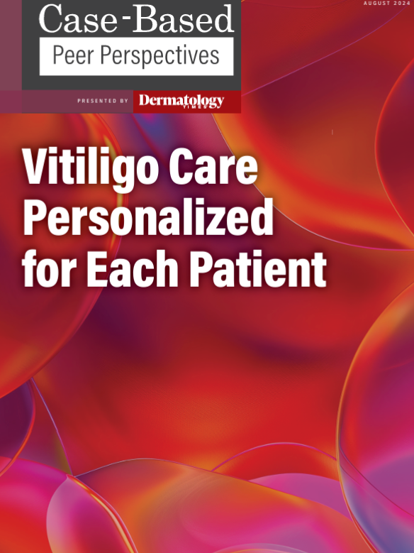 Vitiligo Care Personalized for Each Patient: Part 2