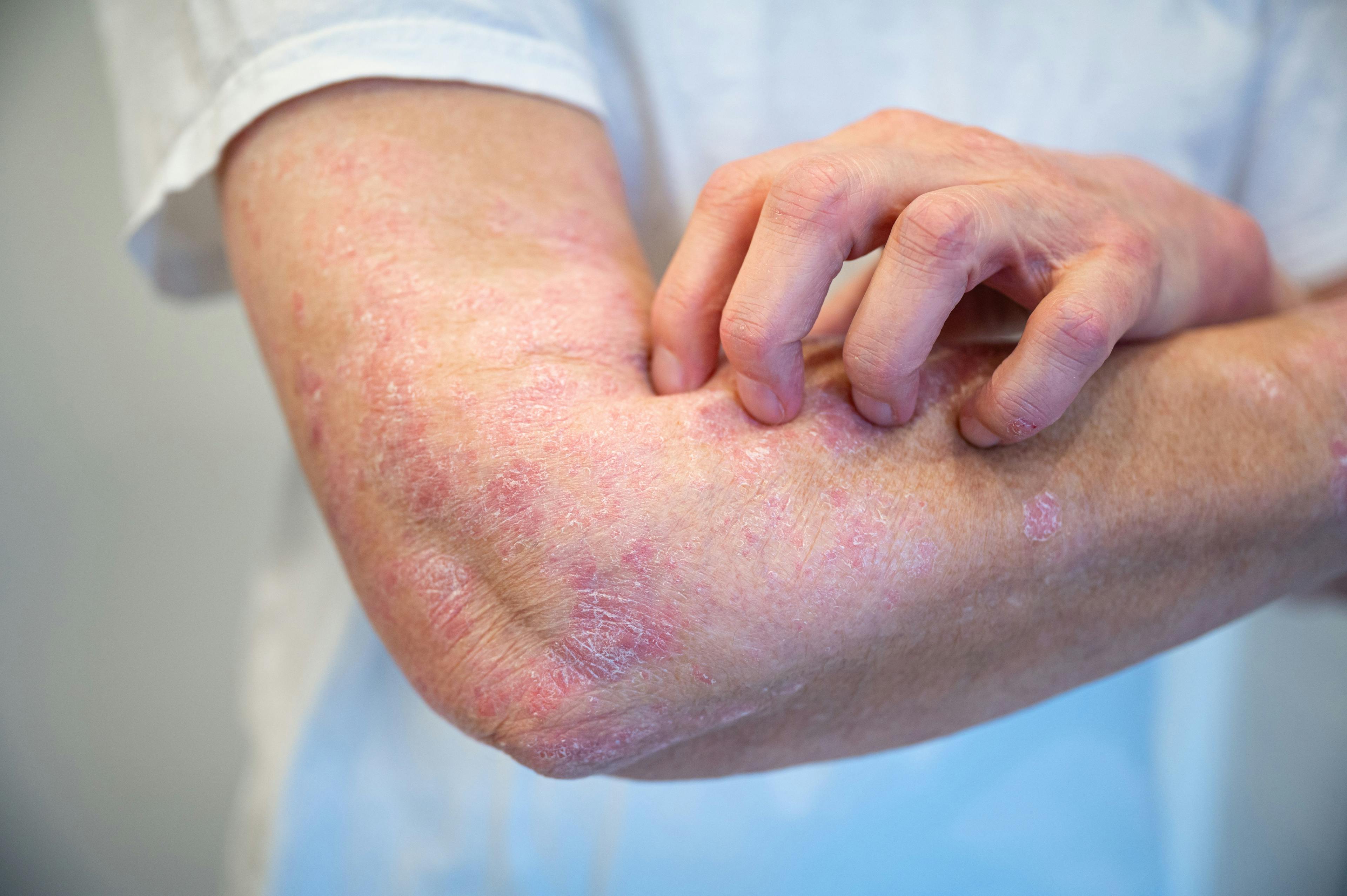 Oral Therapies Offer New Options for Patients With Psoriasis