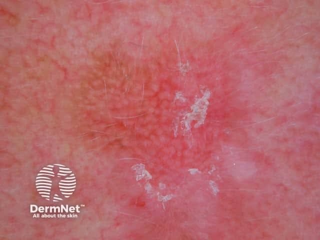 First Study Reveals Covariate-Adjusted Effects of New Actinic Keratosis Therapies for Face and Scalp