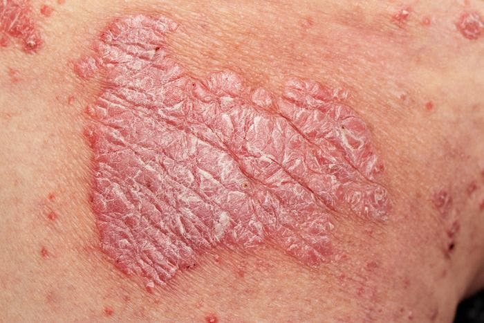 Brodalumab Performs in Phase 4 Studies of Moderate to Severe Psoriasis