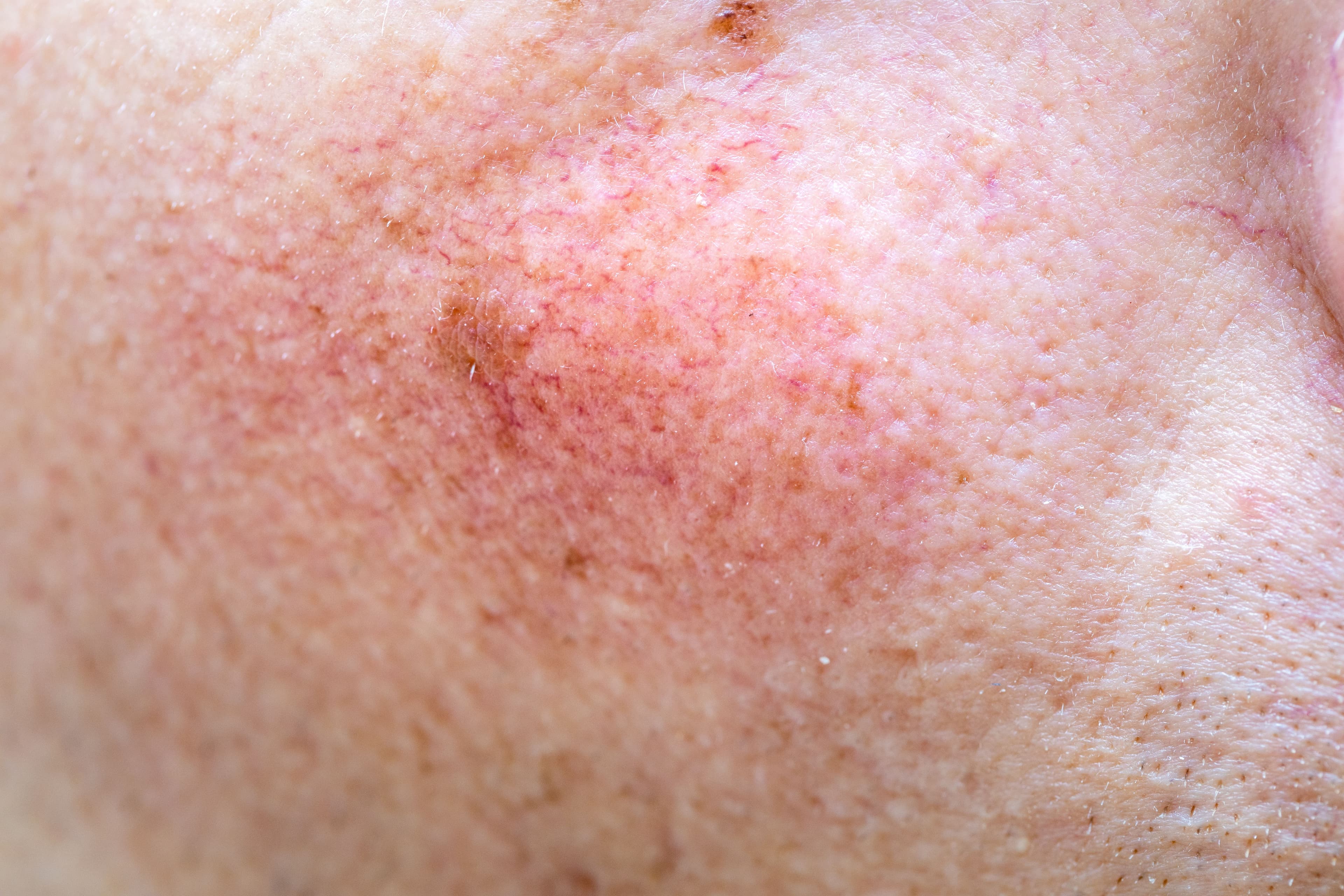 Patient with rosacea on cheeks | Image Credit: © Rochu_2008 - stock.adobe.com