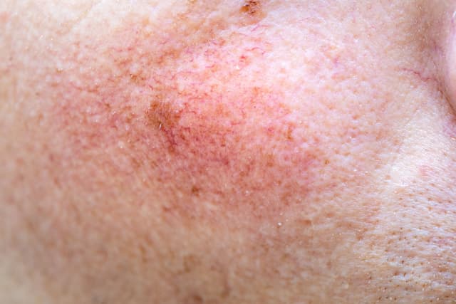 New TRoSA Scale Standardizes Telangiectasia Severity in Rosacea