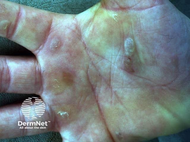 Epidermolysis bullosa