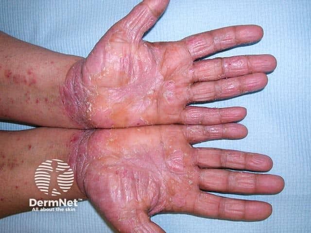 Bilateral psoriasis eruption that arose during adalimumab treatment for inflammatory bowel disease | Image credit: DermNet