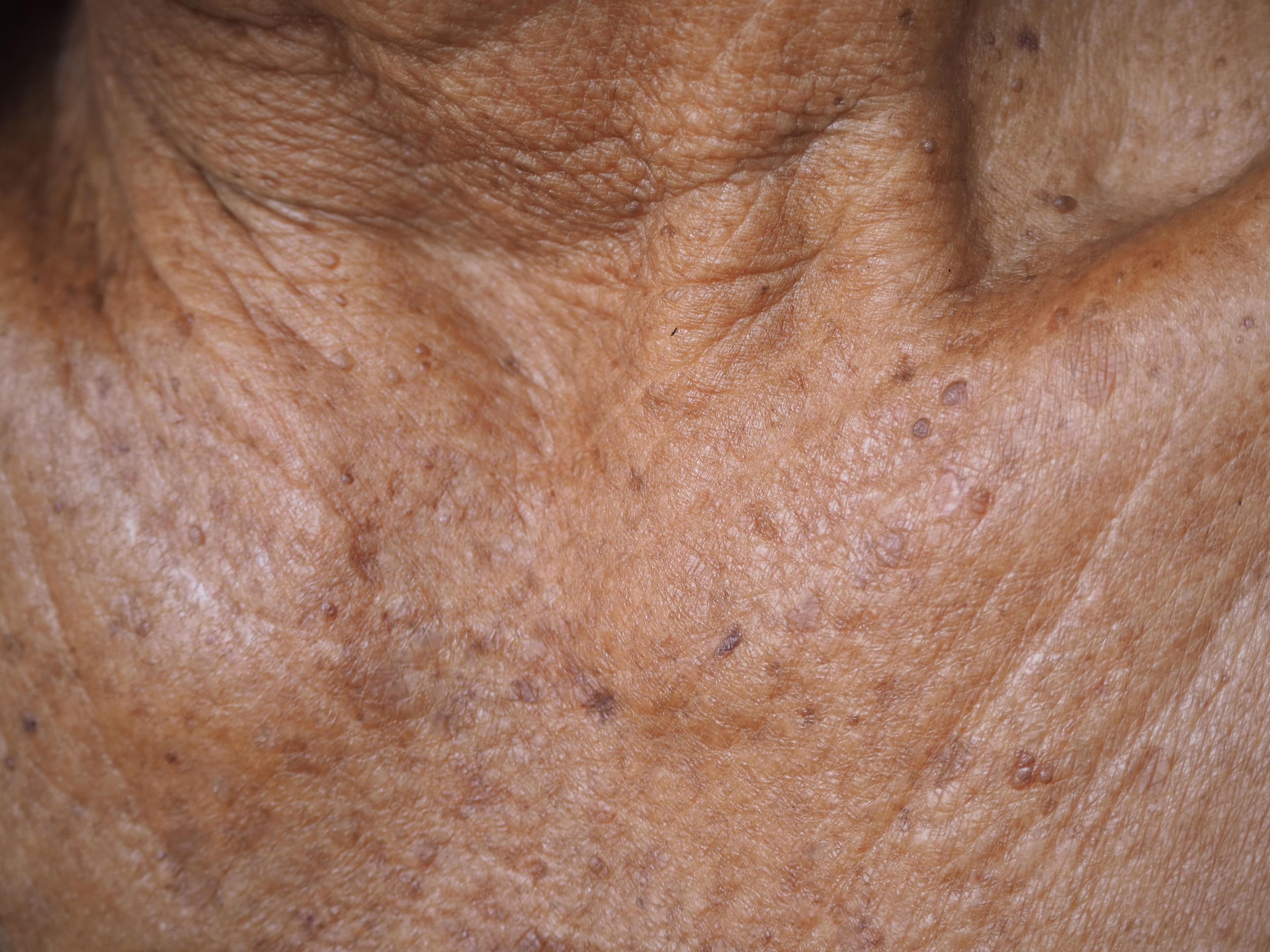 Patient with actinic keratosis | Image Credit: © jaojormami - stock.adobe.com