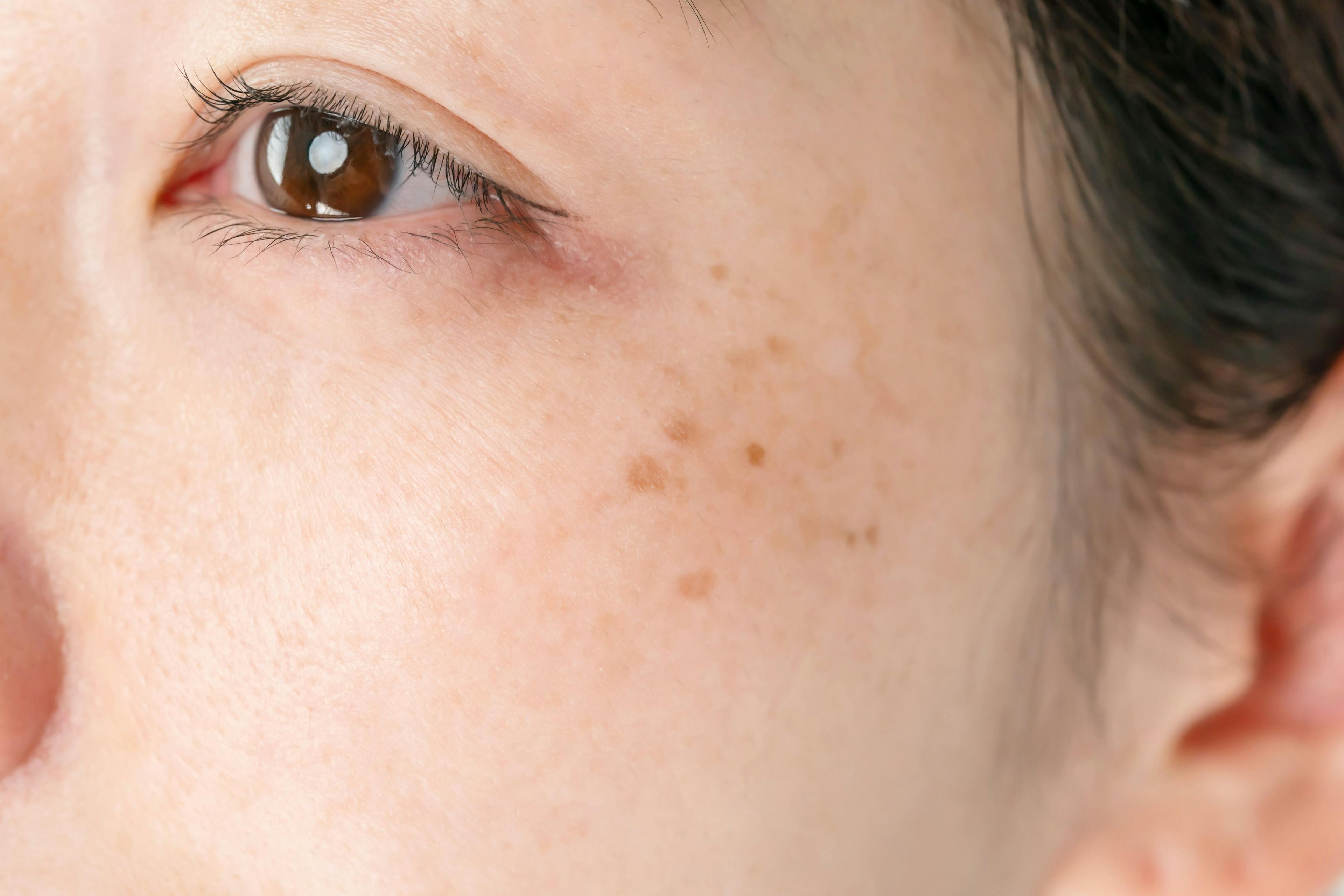 Melasma/freckling on a woman's cheek