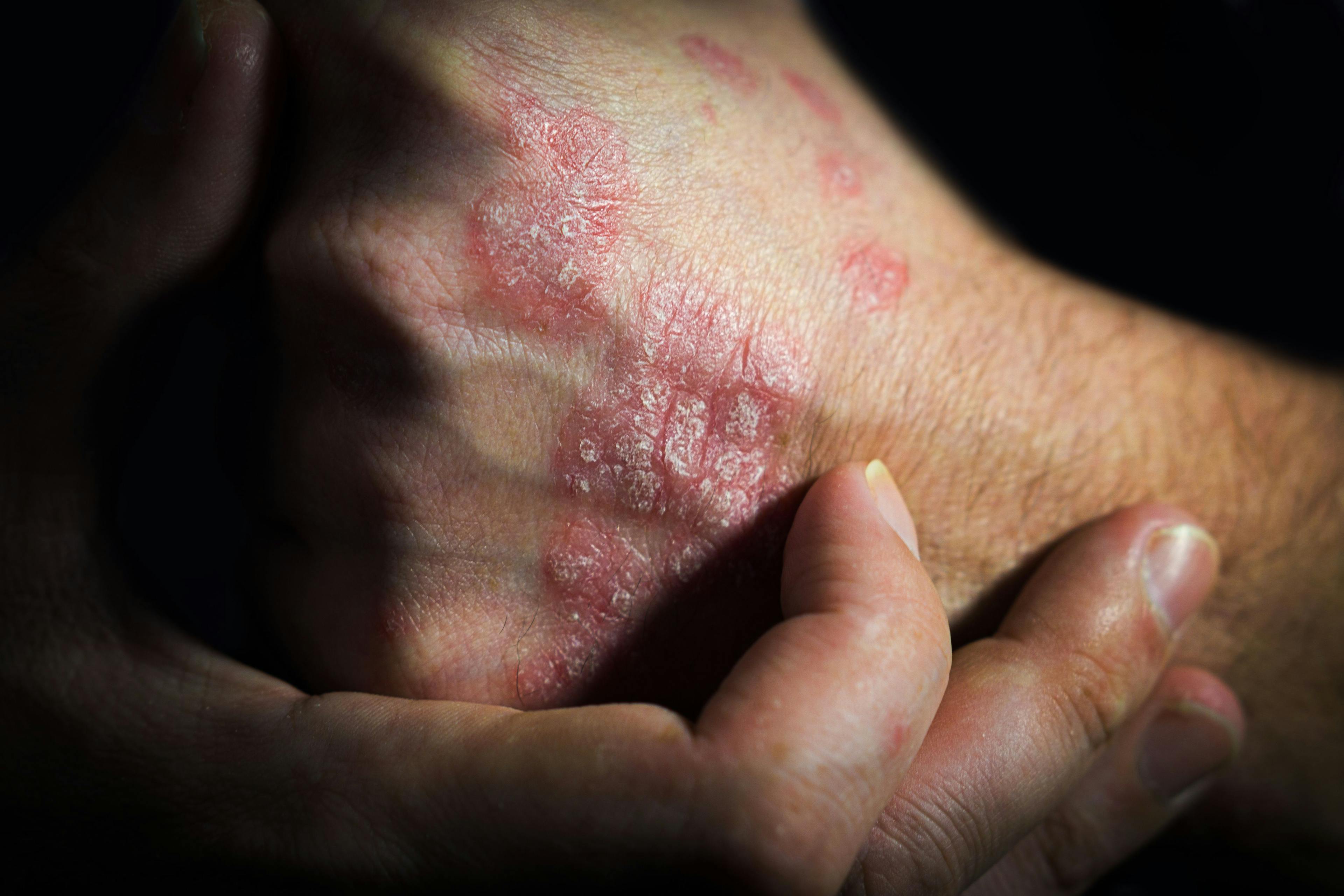 Low Stress Resilience in Men Linked to Higher Risk of Psoriasis and Psoriatic Arthritis