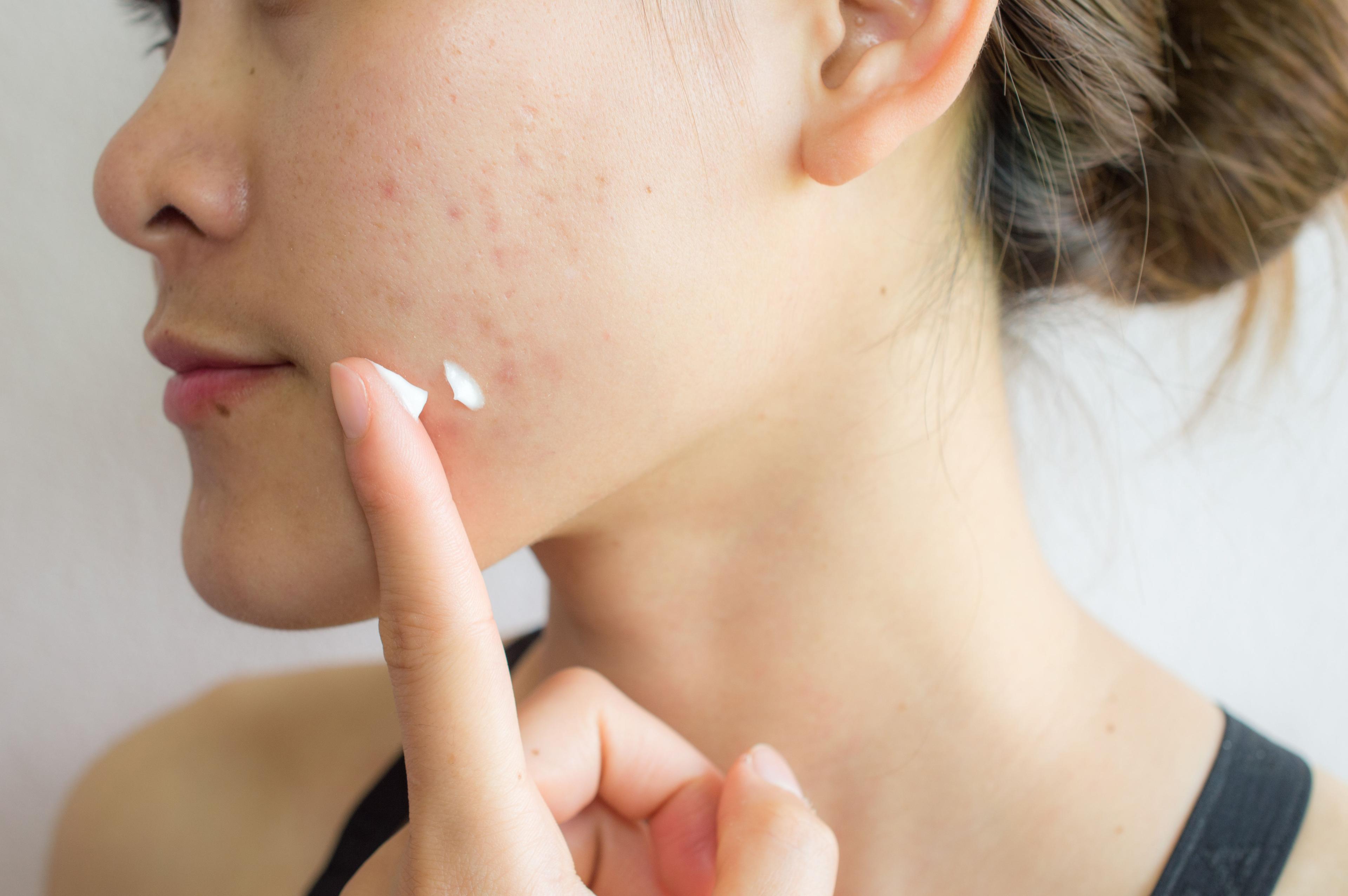 Exploring Safe Alternatives to BPO: Addressing Benzene Risks in Acne Treatments 