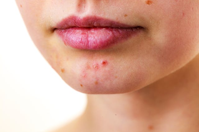Physicians Should Prepare for Potential Acne Vulgaris Misinformation Correction, Report Says