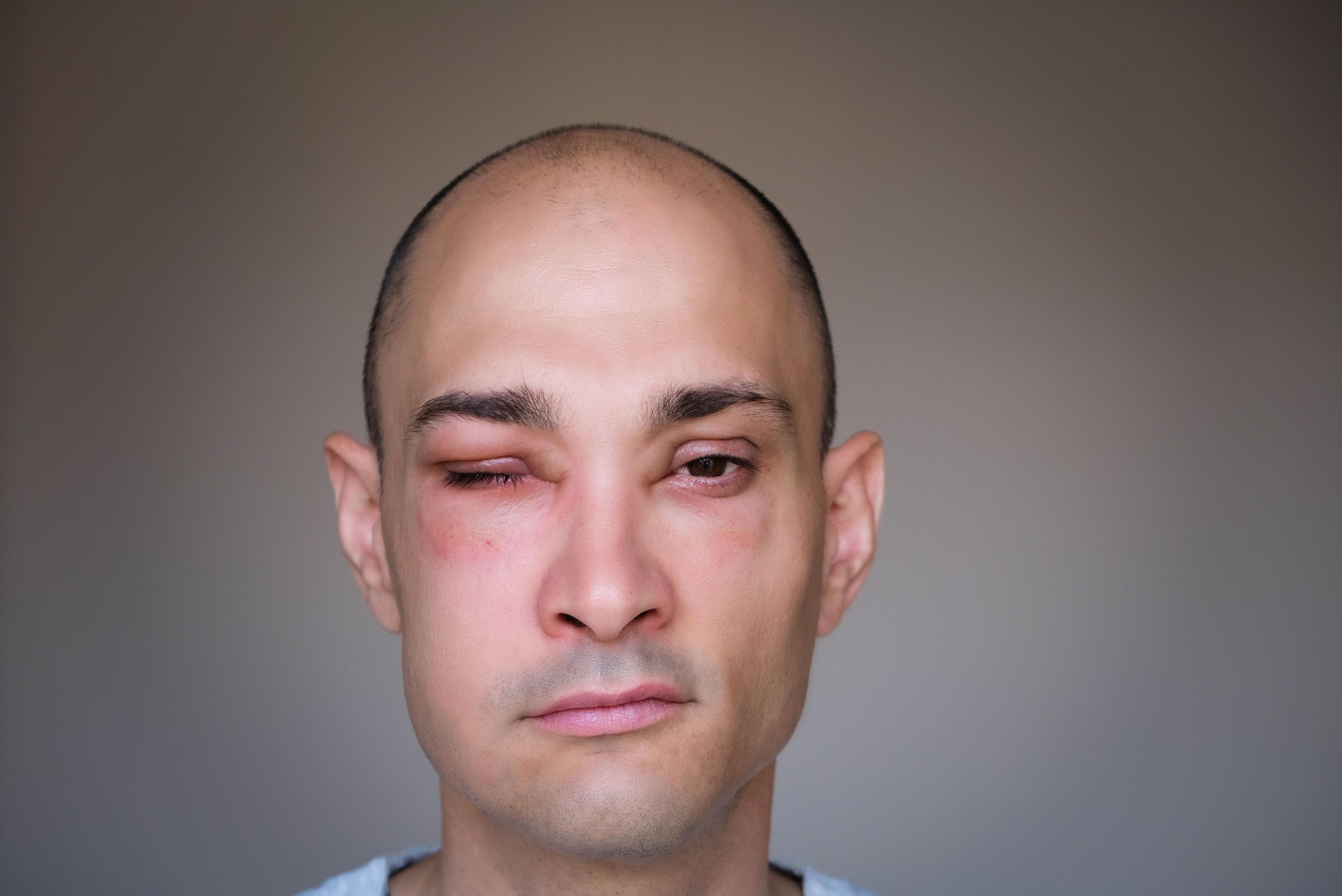 Caucasian man with angioedema affecting the face