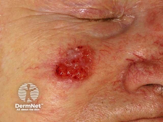 Squamous cell carcinoma on the face