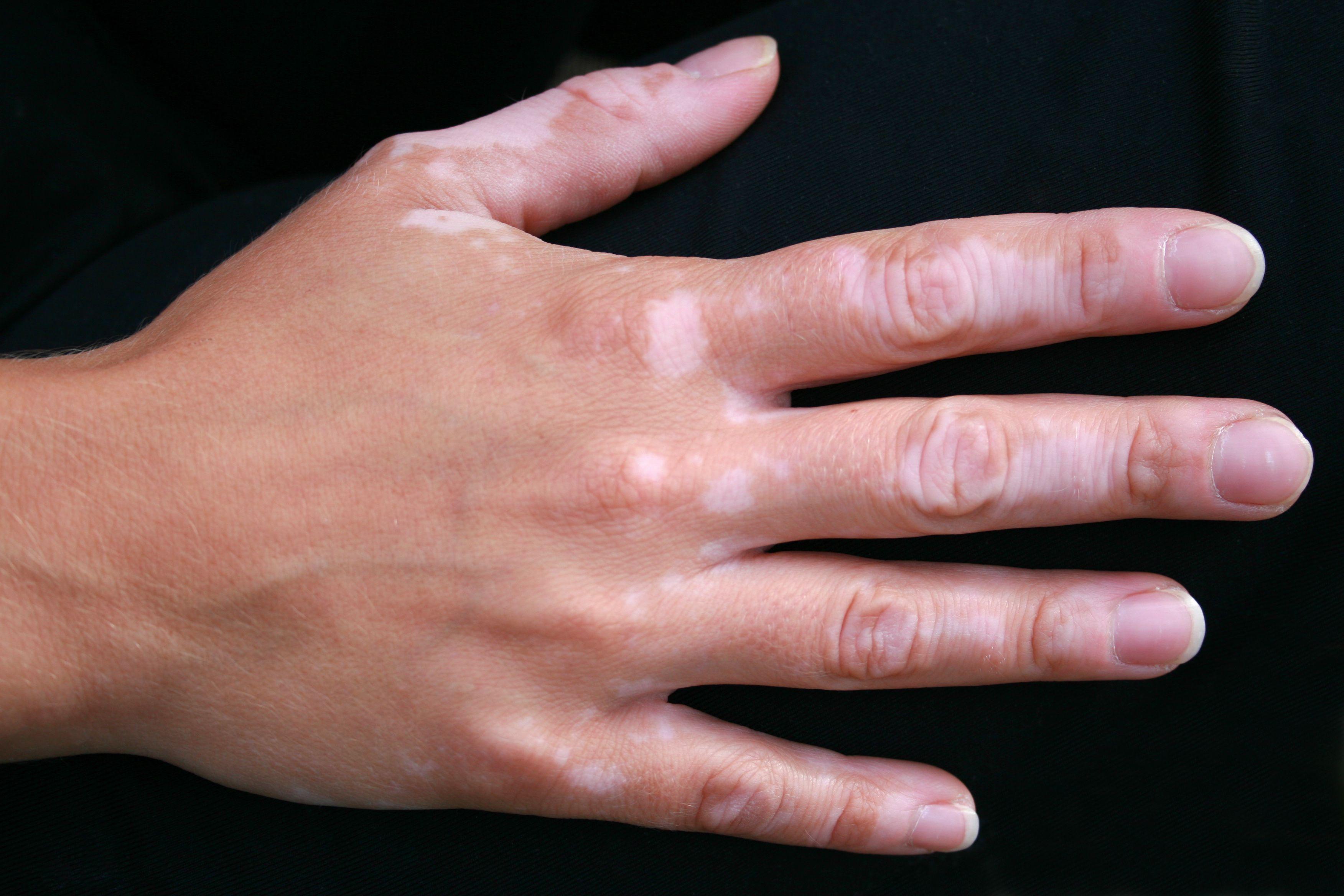 Patient with vitiligo | Image Credit: © nadine - stock.adobe.com