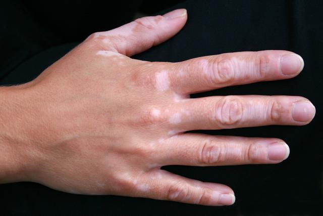 Vitiligo Identified as Possible Risk Factor for Cardiovascular Disease