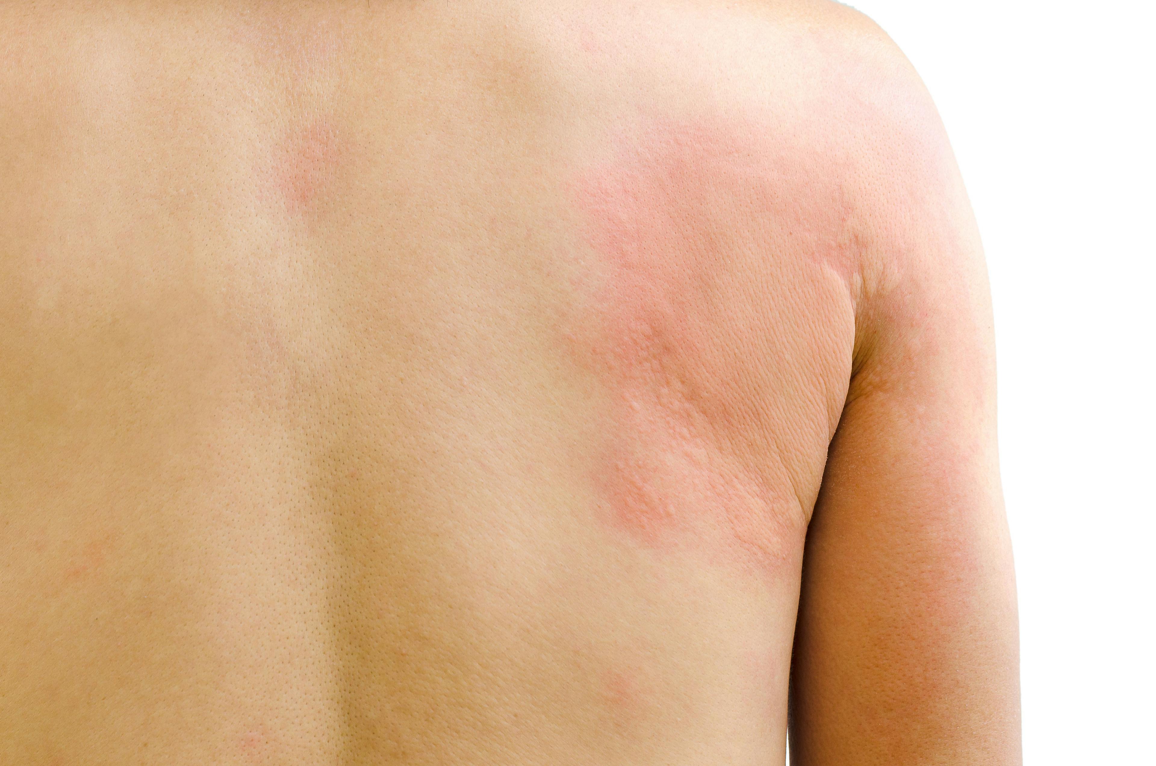 Urticaria on the back of a patient's shoulder/upper arm region