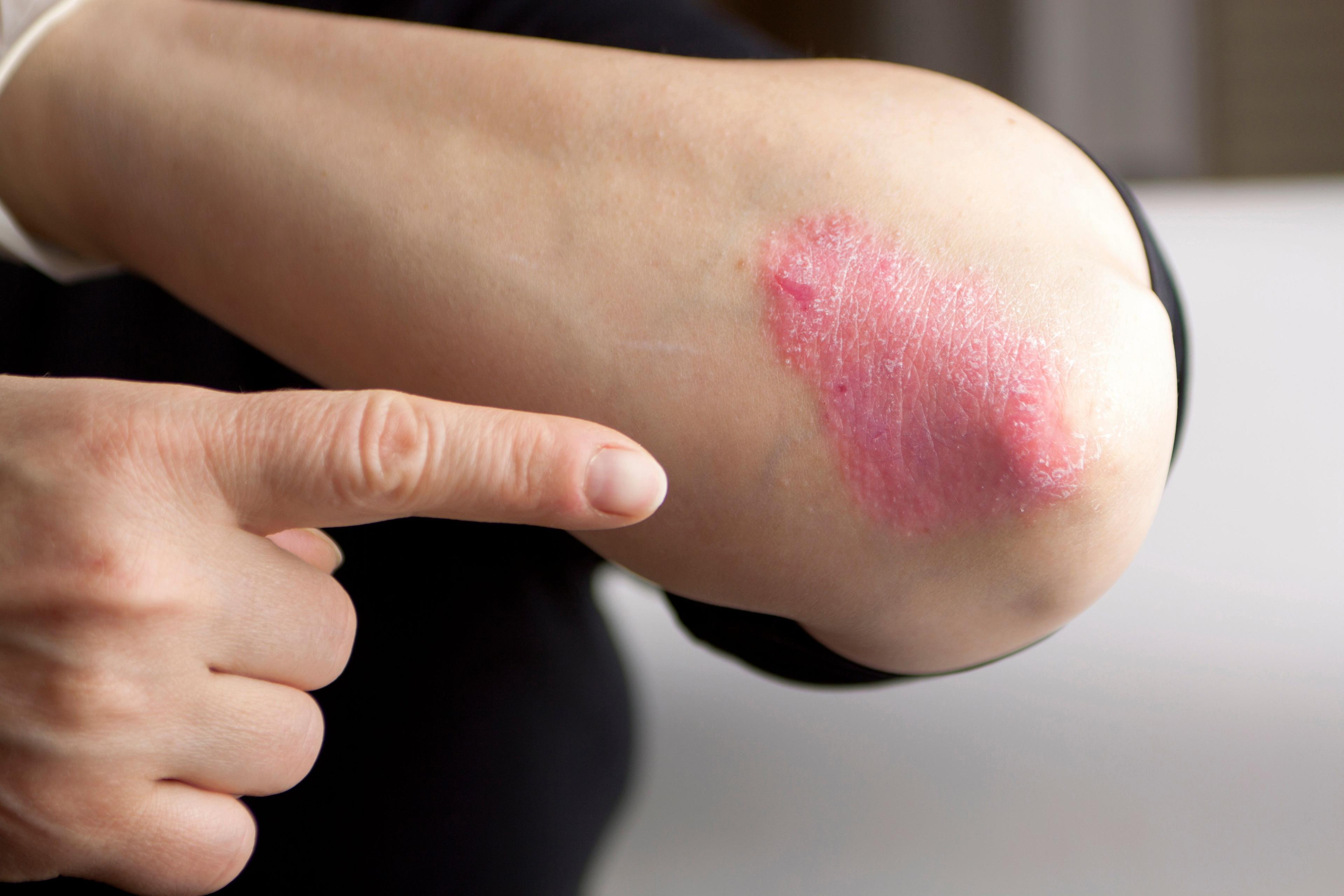 Psoriasis on the elbow