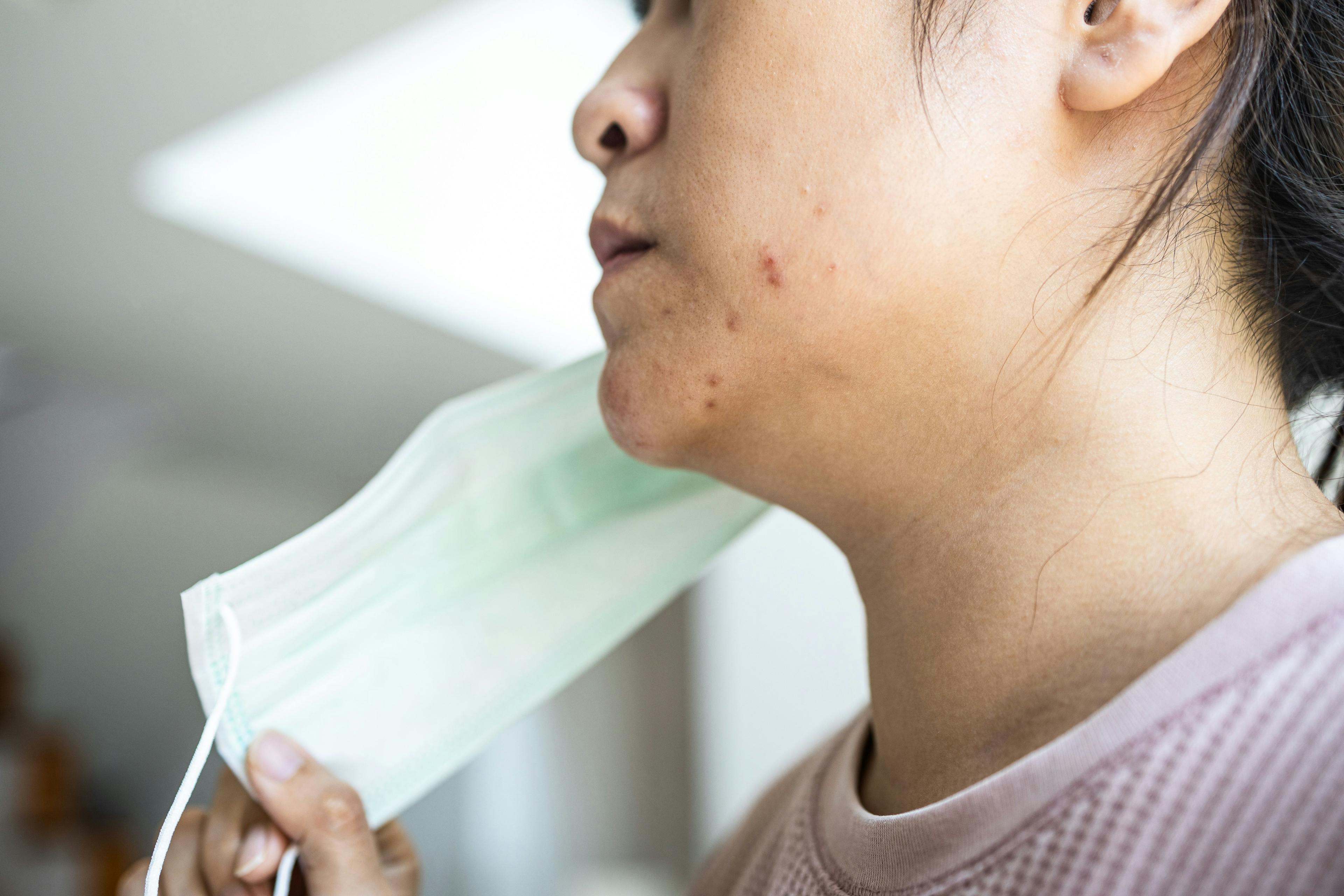 Complex Relationship Between Air Pollutants and Secondary Sensitive Skin in Patients With Acne 