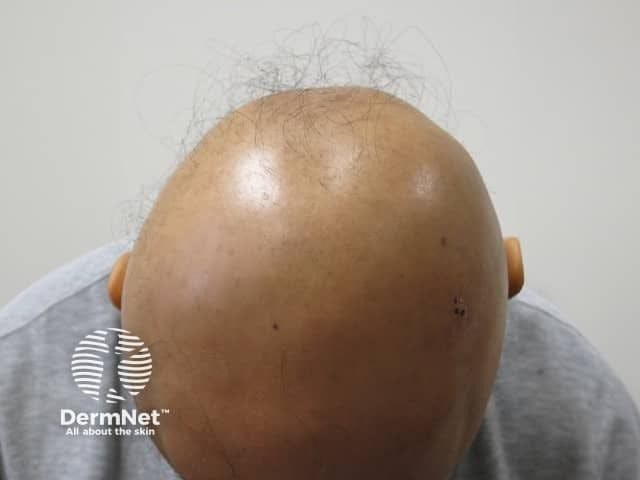 Alopecia areata on the top of the scalp | Image credit: DermNet