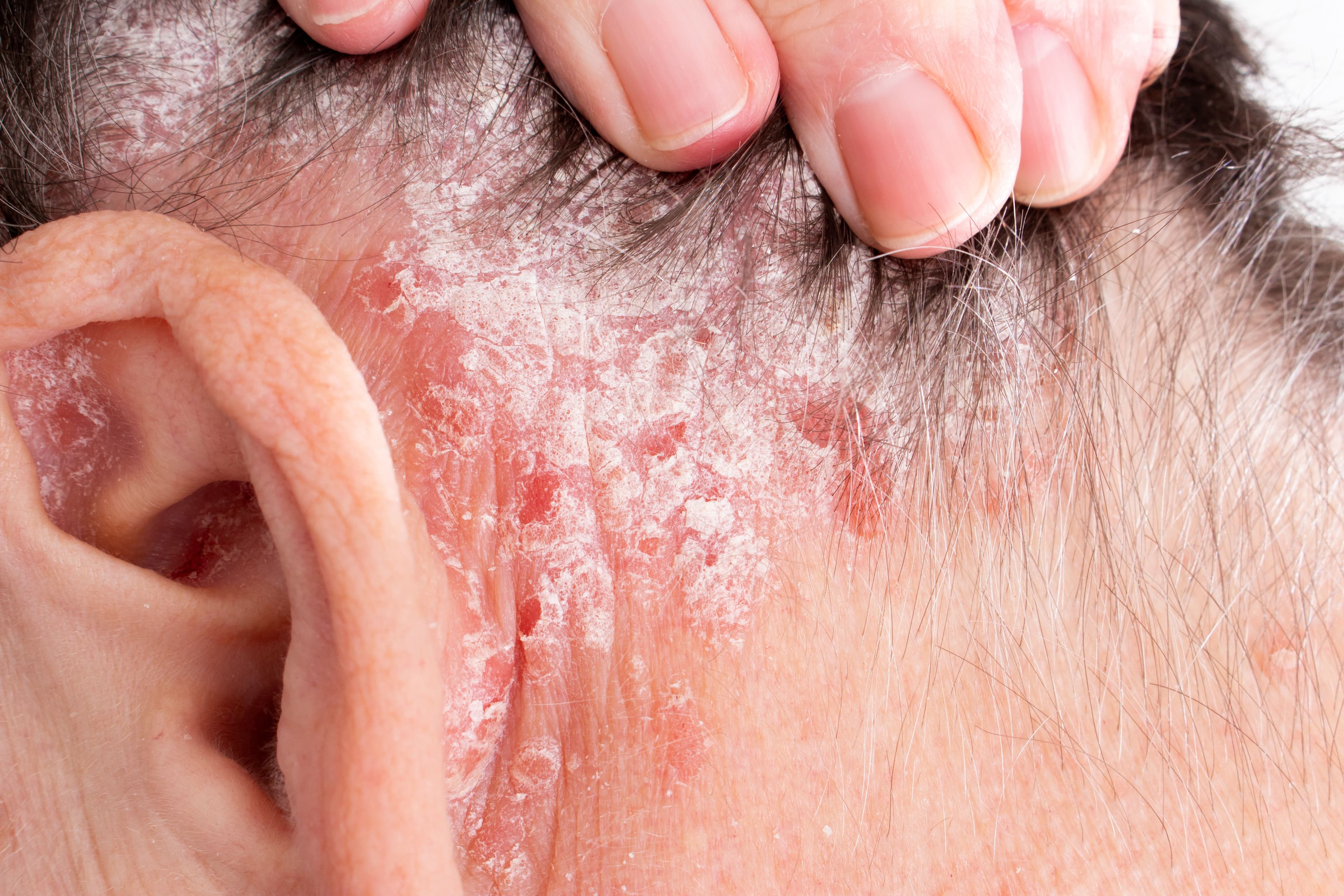 Psoriasis on scalp and ear