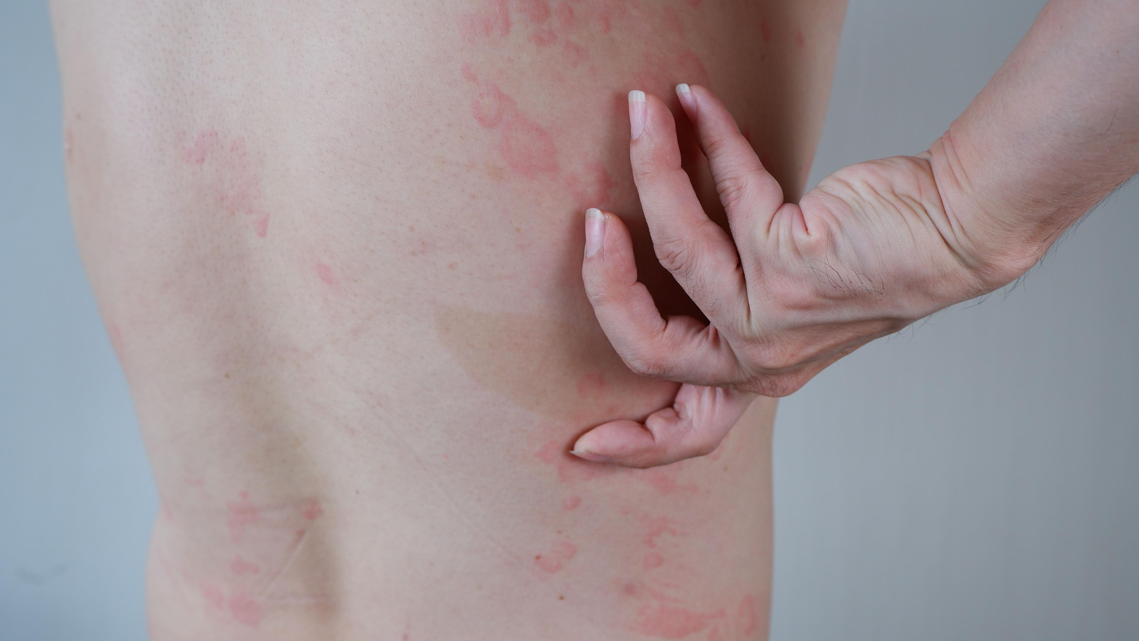 Patient with urticaria on back | Image Credit: © wisely - stock.adobe.com