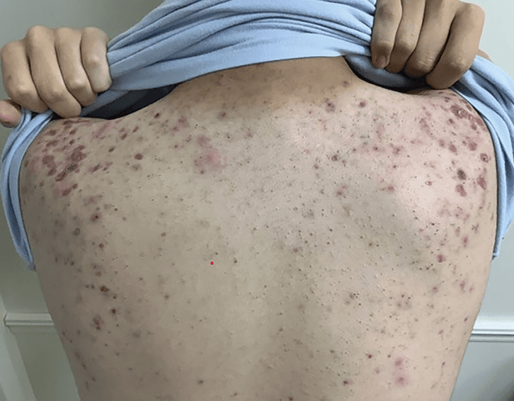 15-year-old patient with recalcitrant acne