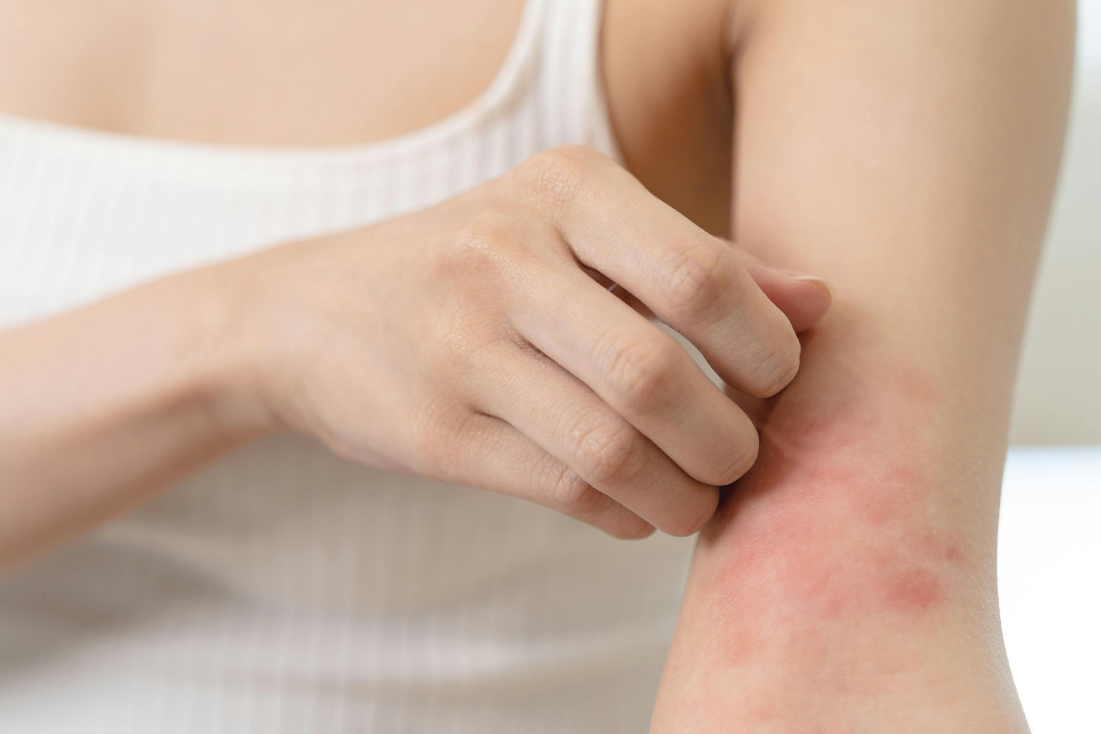 Close up view of woman scratching her arm