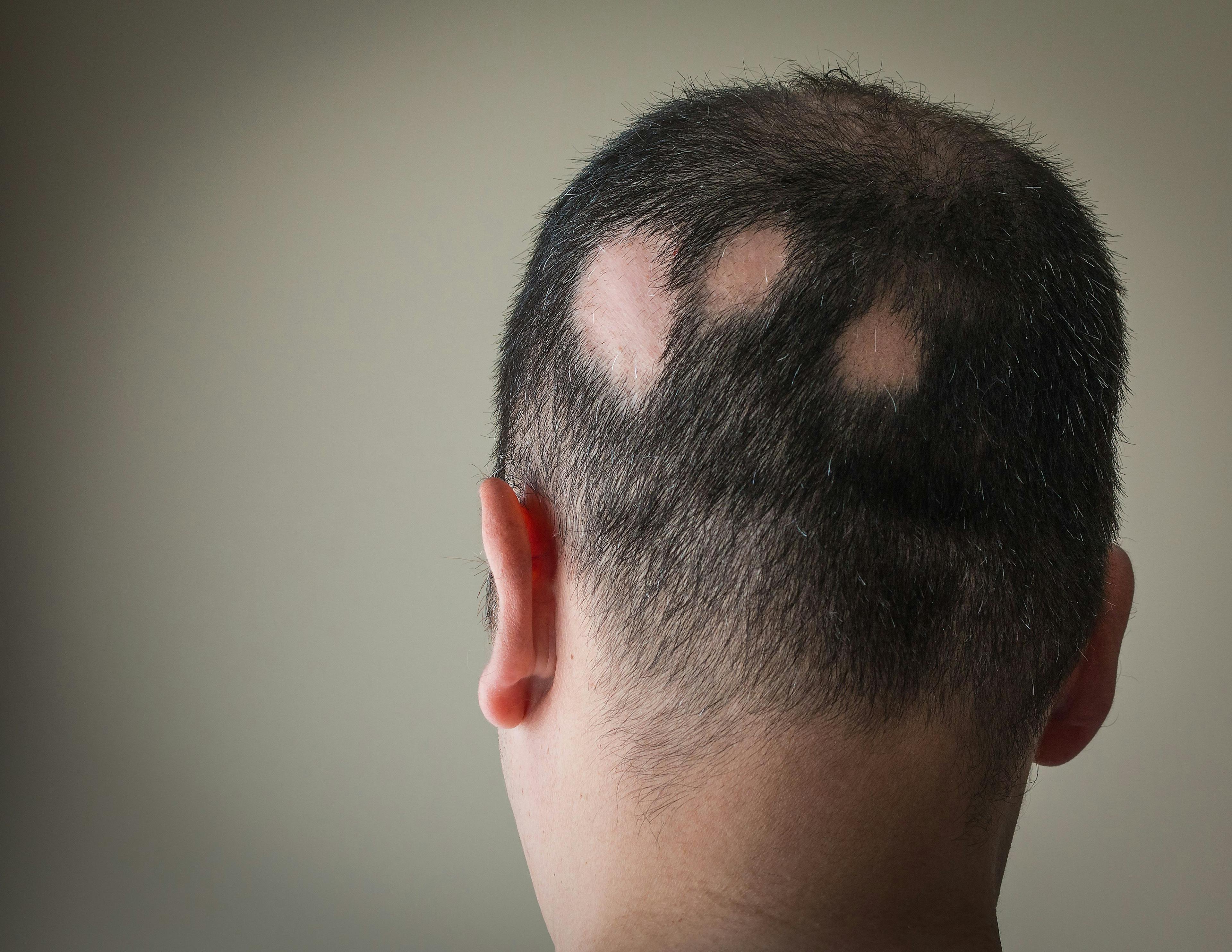 Patient with Alopecia | Image Credit: © Alex Papp - stock.adobe.com