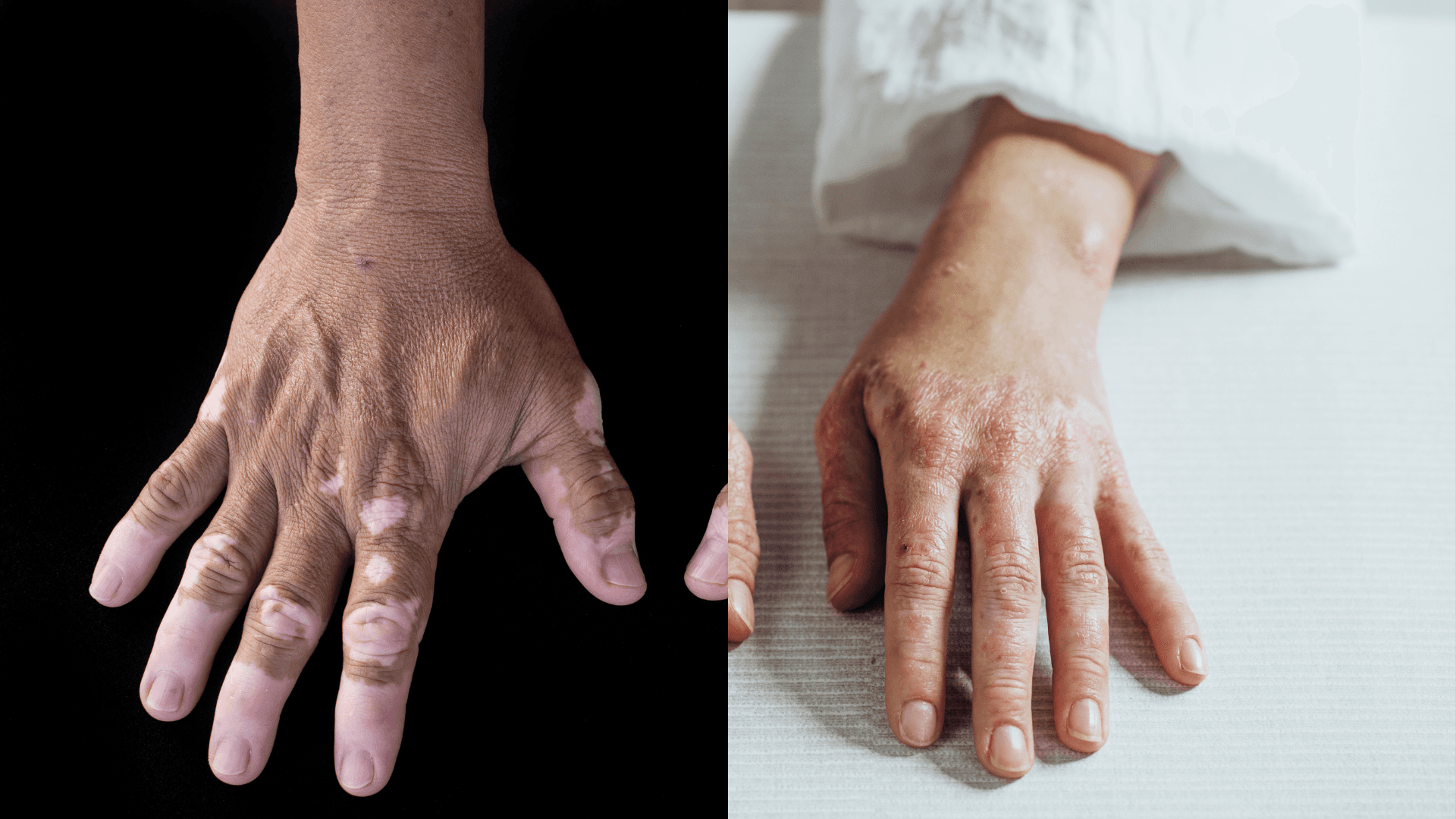 Relationship Between Vitiligo and Psoriasis May Be Due, In Part, to Immunity