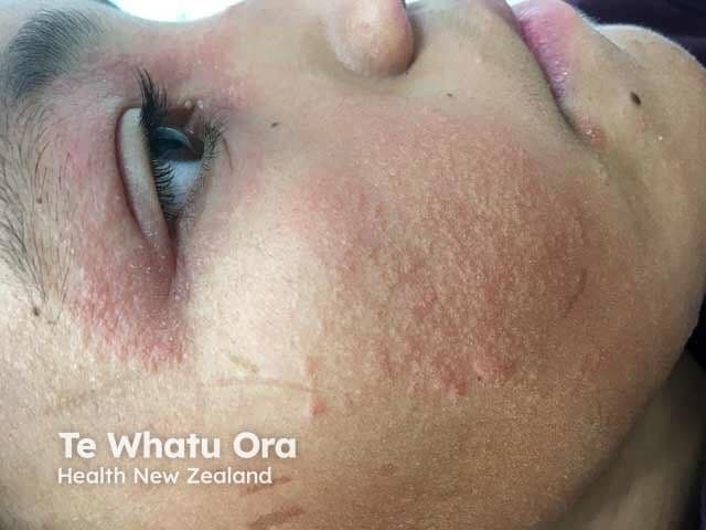 Child with Atopic Dermatitis | Image Credit: © dermnetnz.org