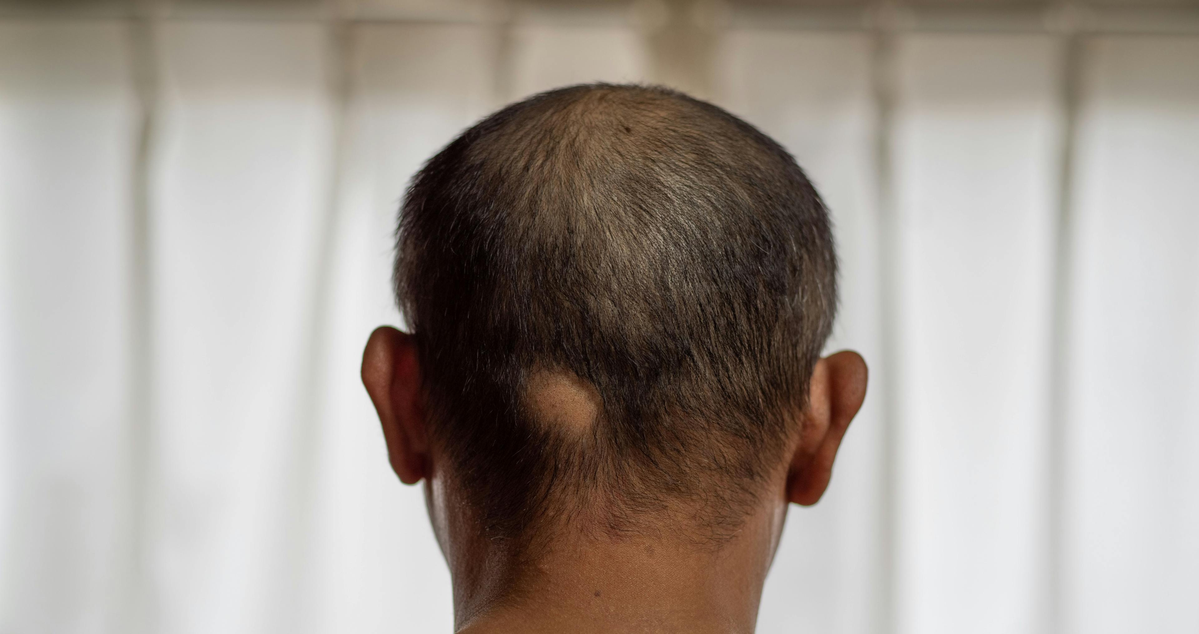 Man with alopecia located on the back of the head