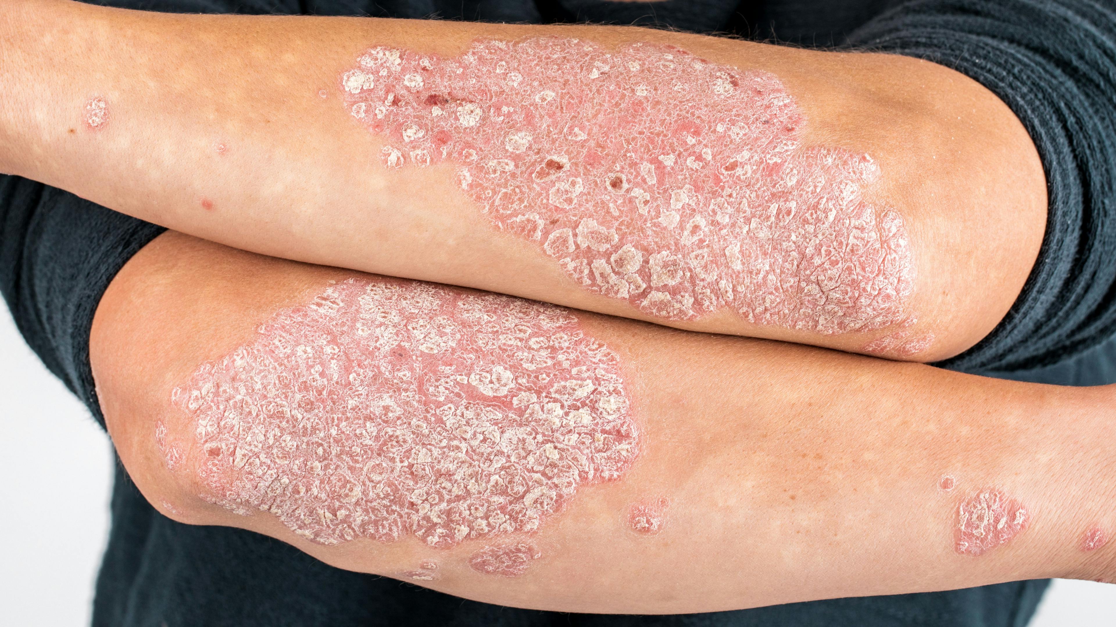 Almirall Launches Wynzora Cream for Plaque Psoriasis in Europe 