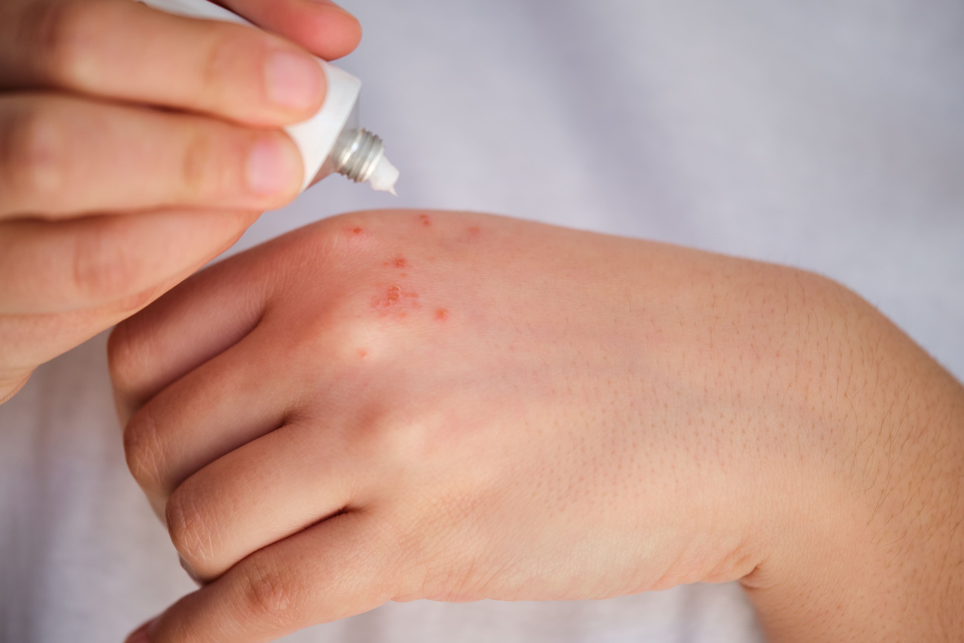 Topical corticosteroid cream for atopic dermatitis of the hand