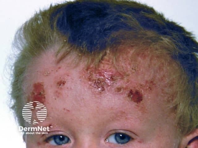 Child with atopic dermatitis | Image Credit: © dermnetnz.org