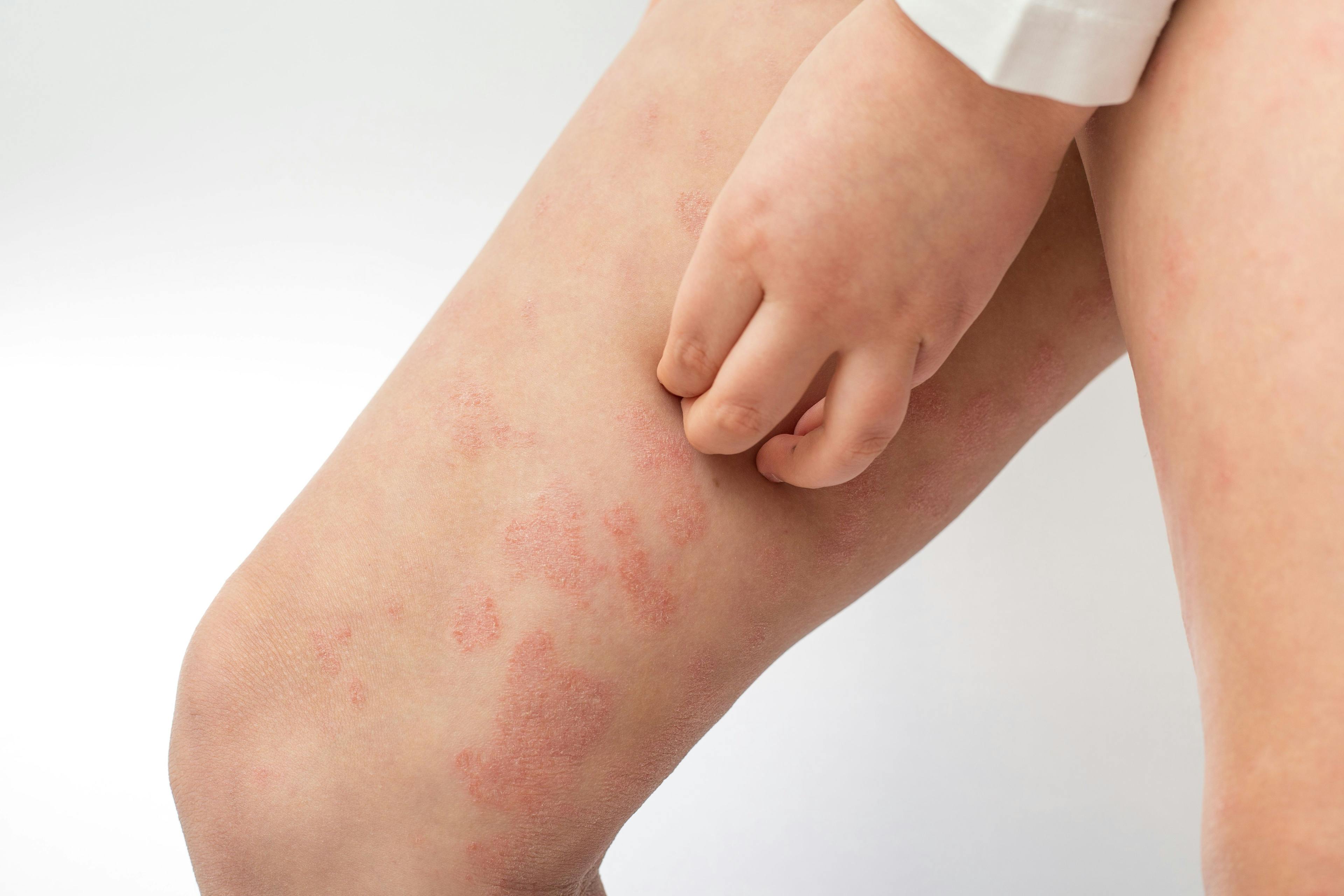 Ixekizumab Yields Early, Sustained Improvements to Quality of Life Measures in Pediatric Patients With Plaque Psoriasis