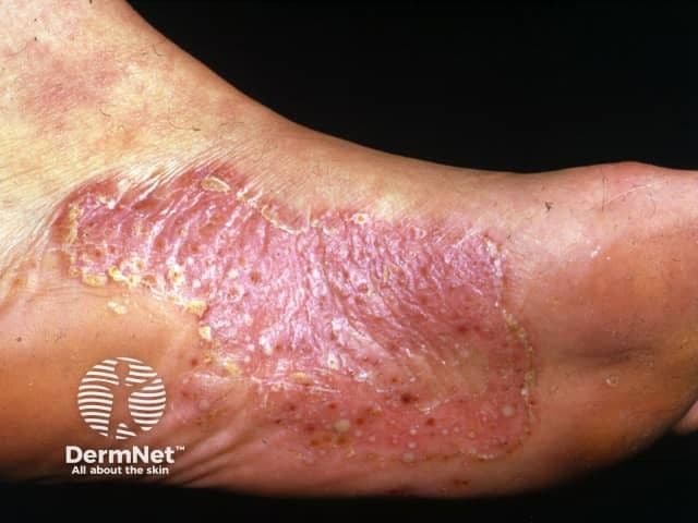 Palmoplantar Pustulosis  | Image credit: © DermNet