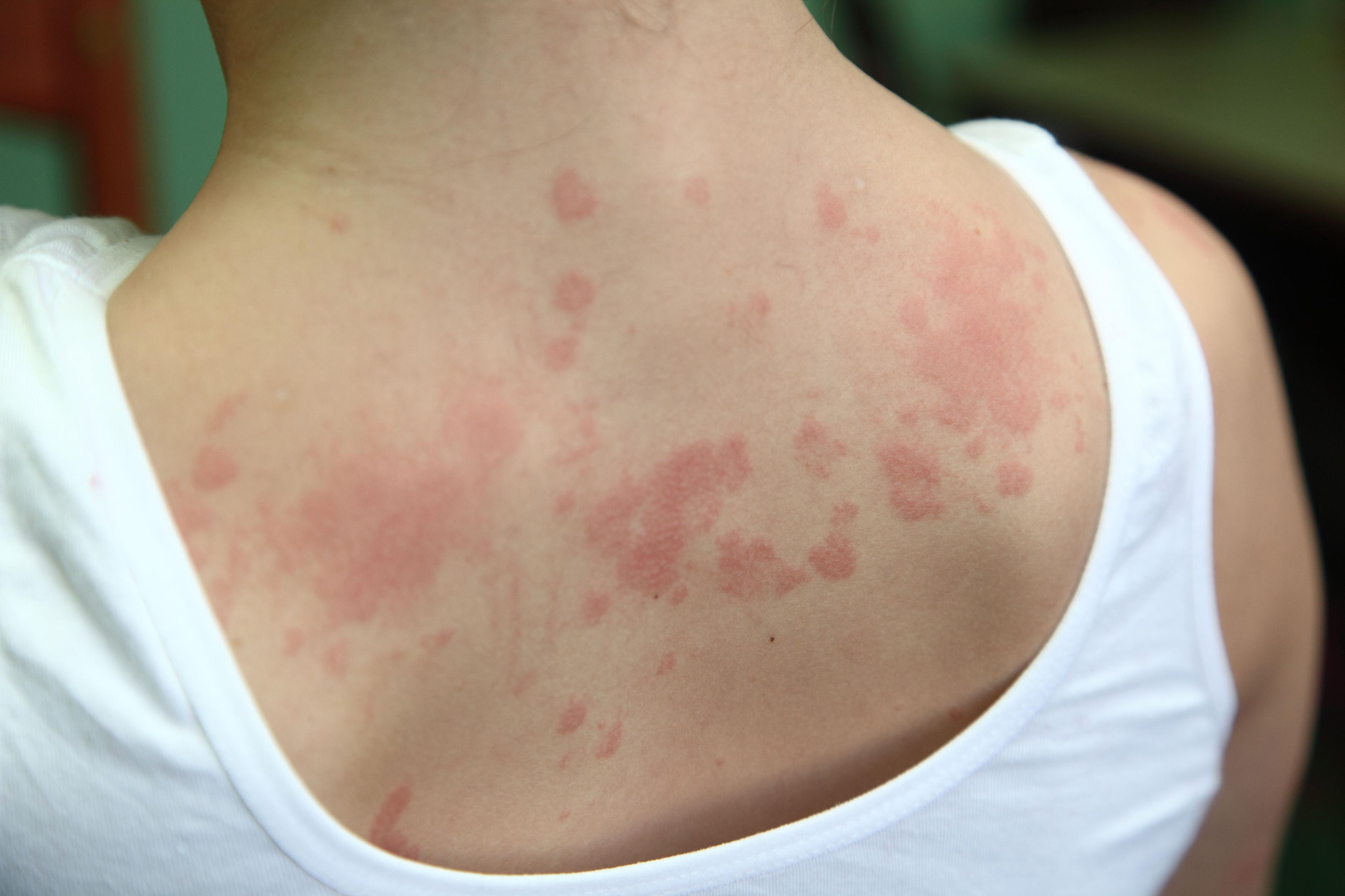 Spontaneous urticaria on the upper back