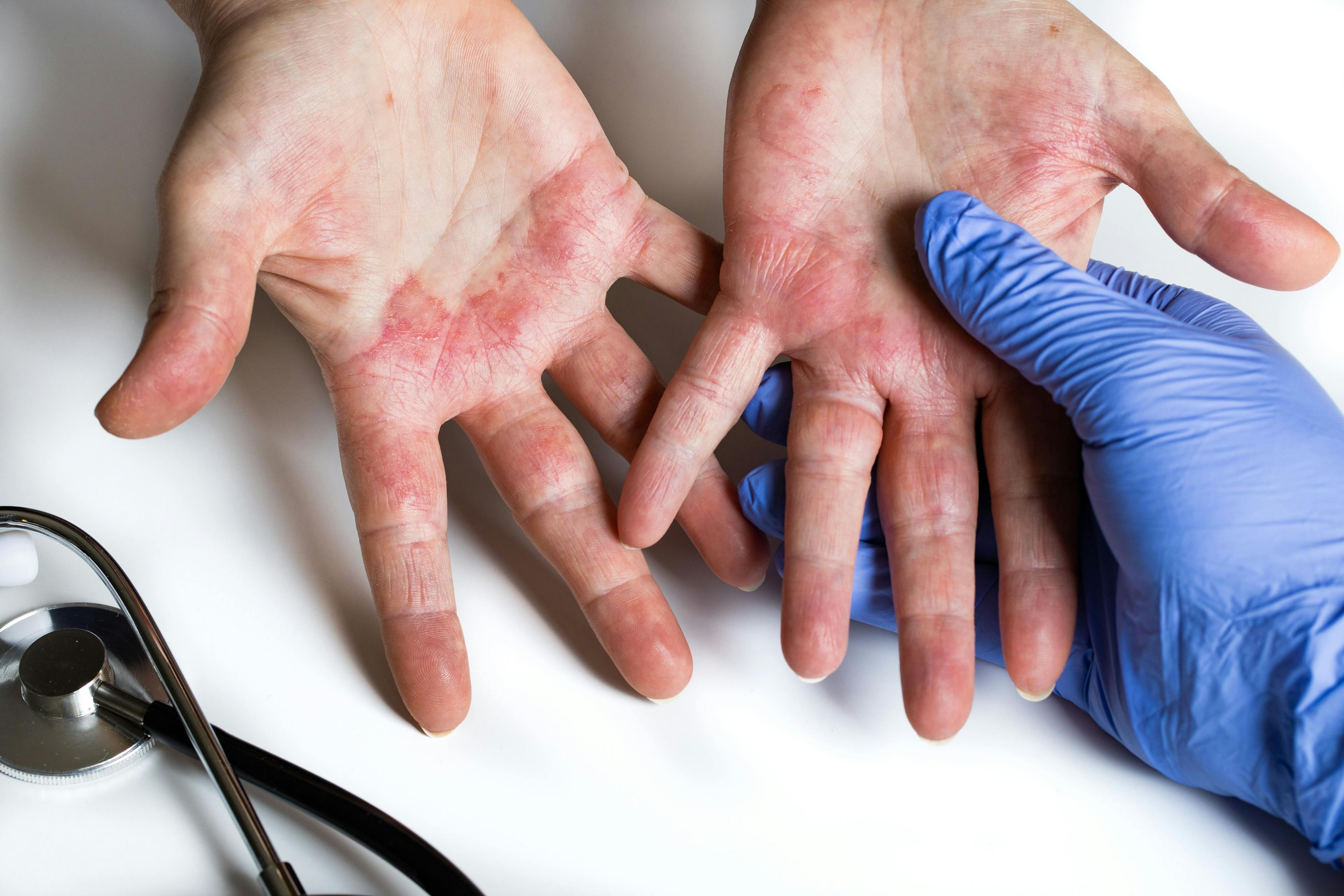 Patient with atopic dermatitis on hands | Image Credit: © Rochu_2008 - stock.adobe.com