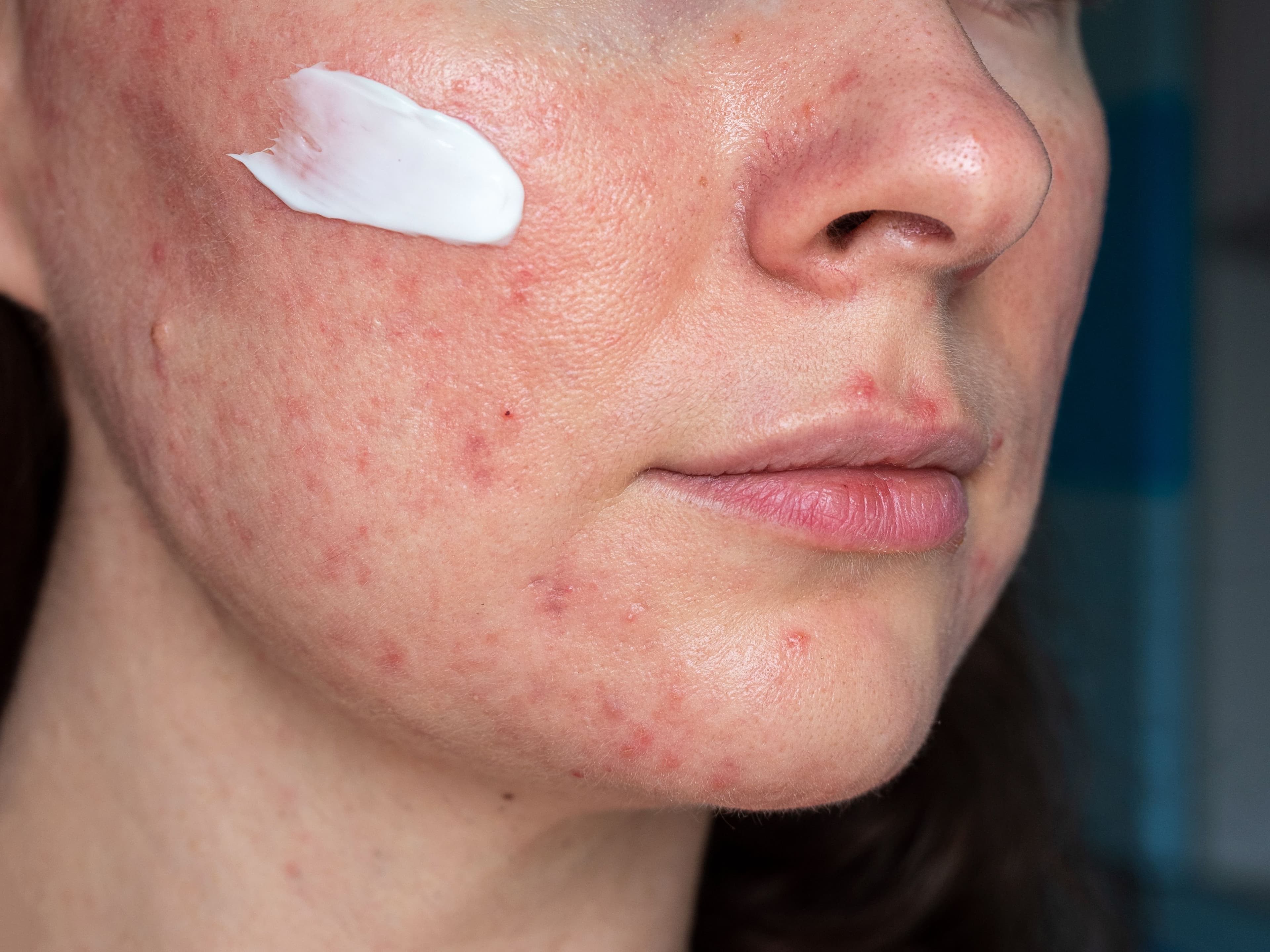 patient with rosacea | Image Credit: © Shauerman - stock.adobe.com