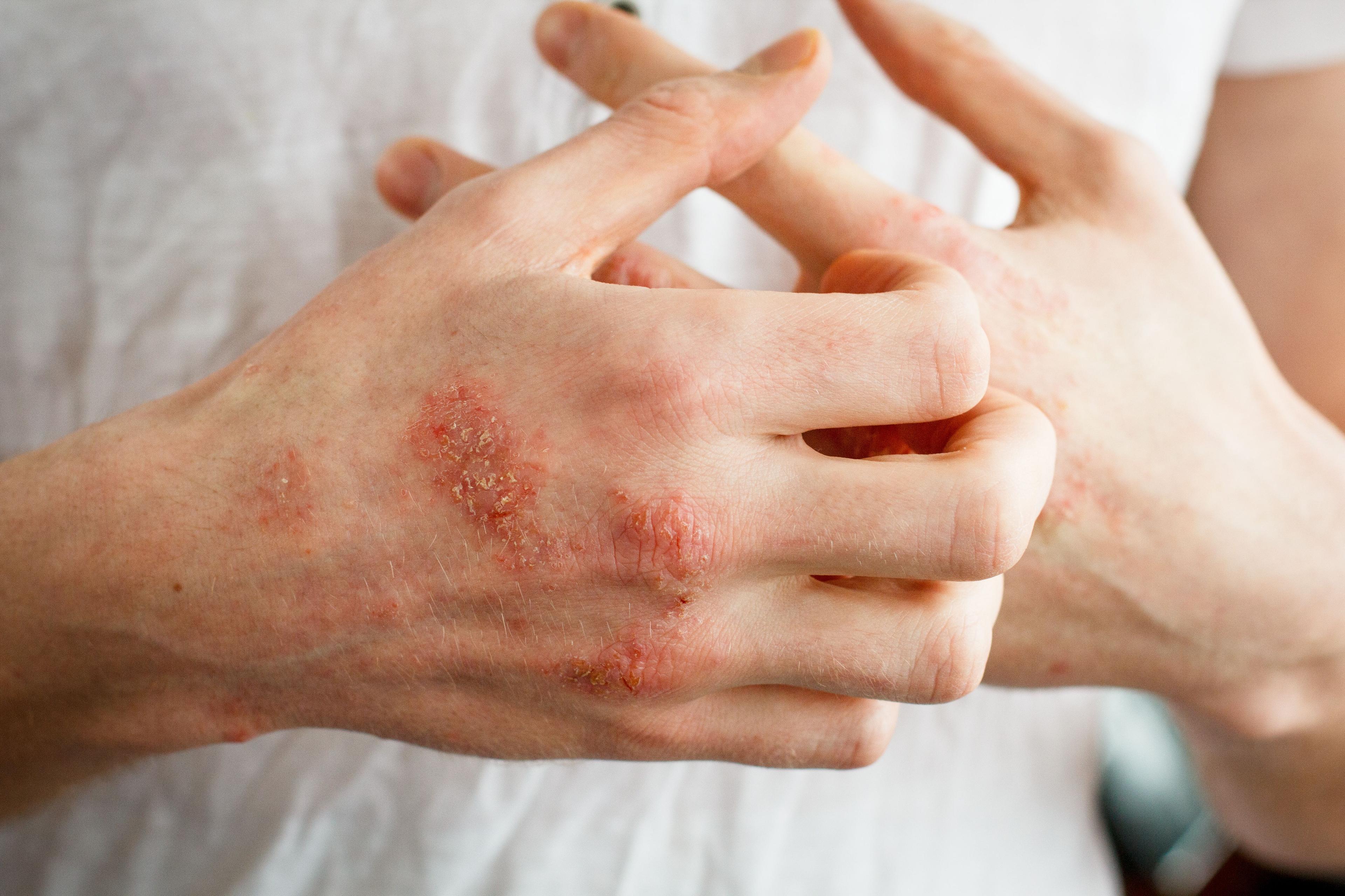 Person with atopic dermatitis on the hands, scratching